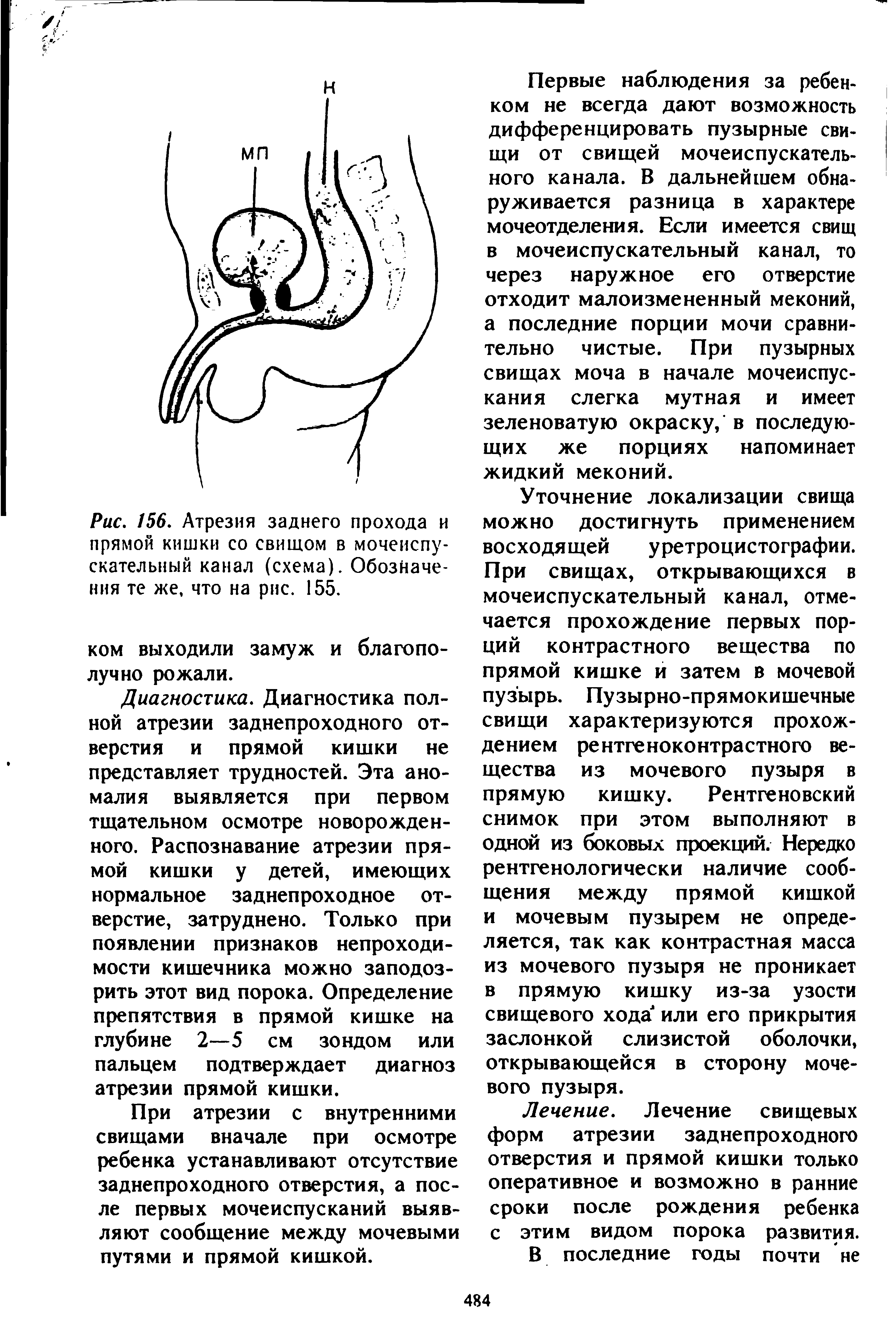 Рис. 156. Атрезия заднего прохода и прямой кишки со свищом в мочеиспускательный канал (схема). Обозначения те же, что на рис. 155.