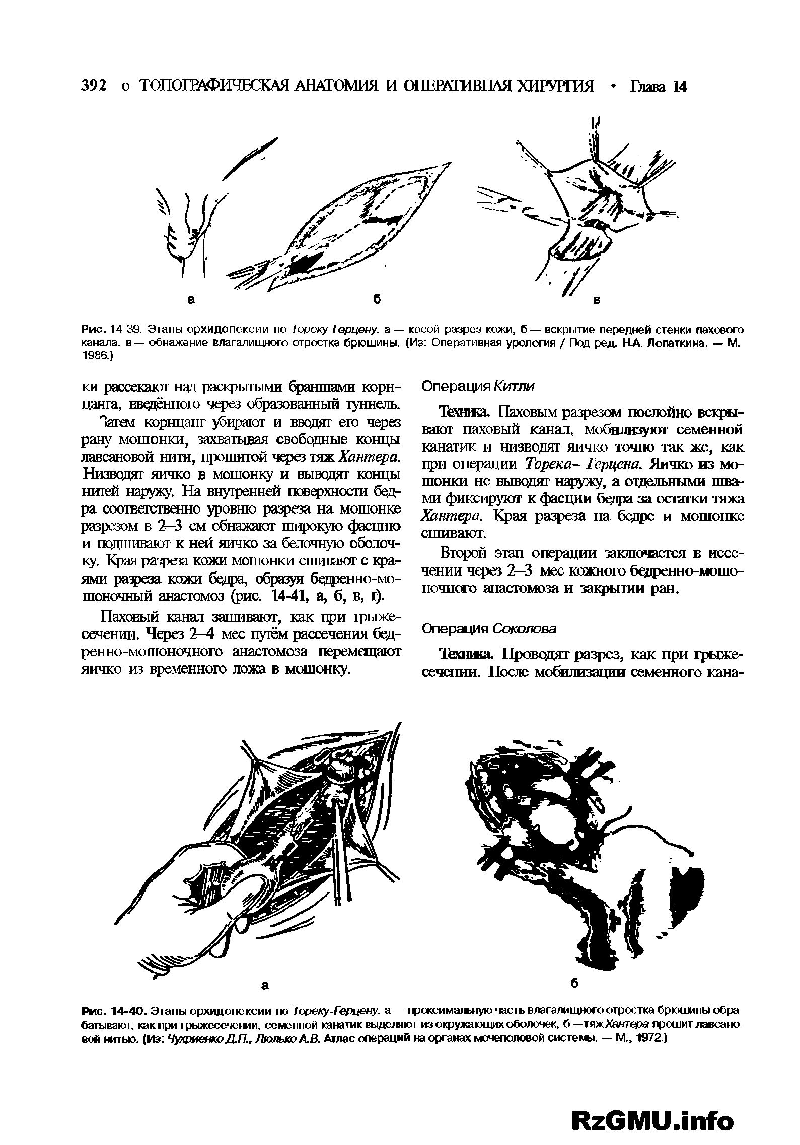 Рис. 14-39. Этапы орхидопексии по Тореку-Герцену. а— косой разрез кожи, б— вскрытие передней стенки пахового канала, в — обнажение влагалищного отростка брюшины. (Из Оперативная урология / Под ред НА Лопаткина. — М. 1986.)...