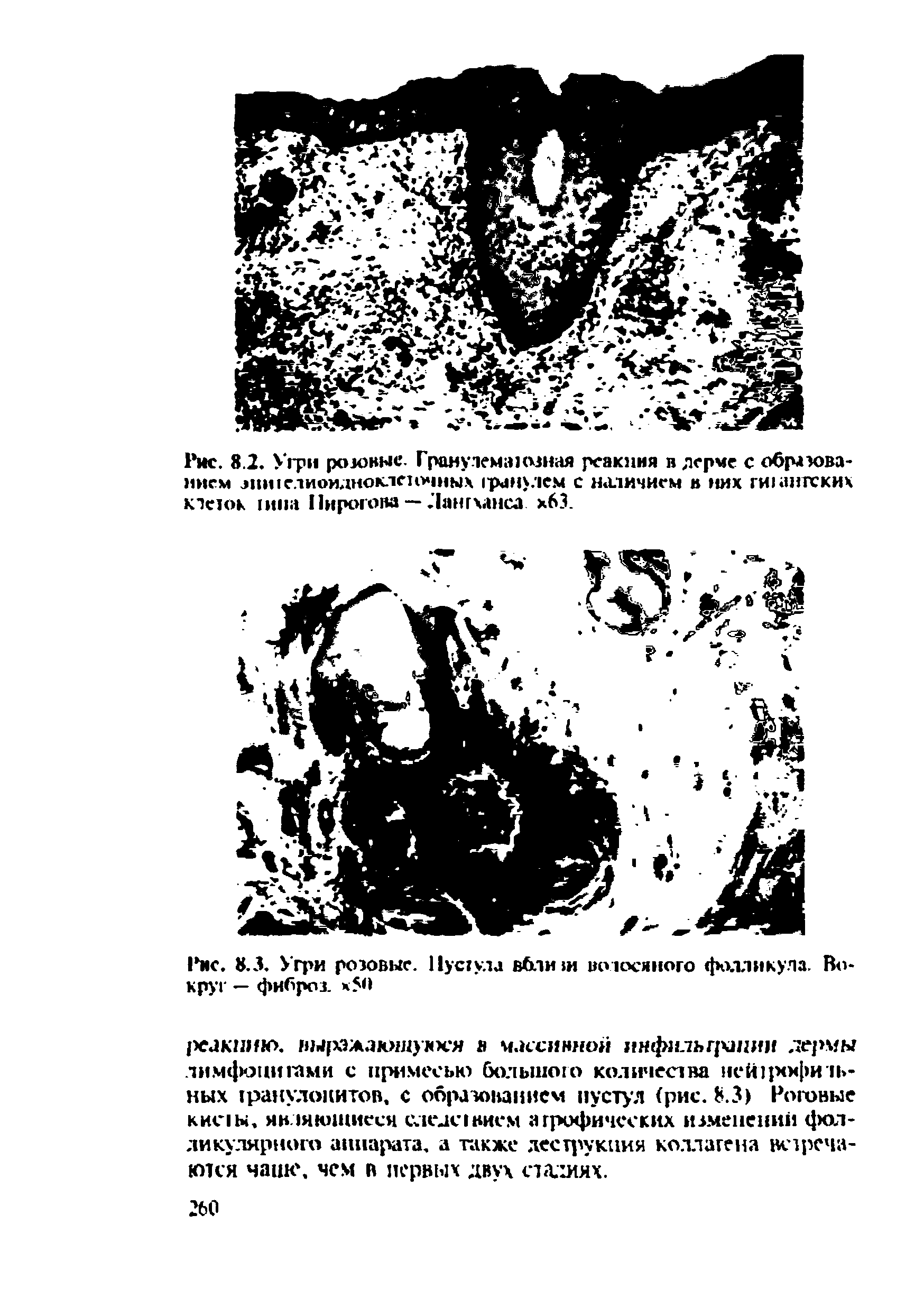 Рис. 8.3. Угри розовые. Пустула вблиги волосяного фолликула. Вокруг — фиброз. х50...