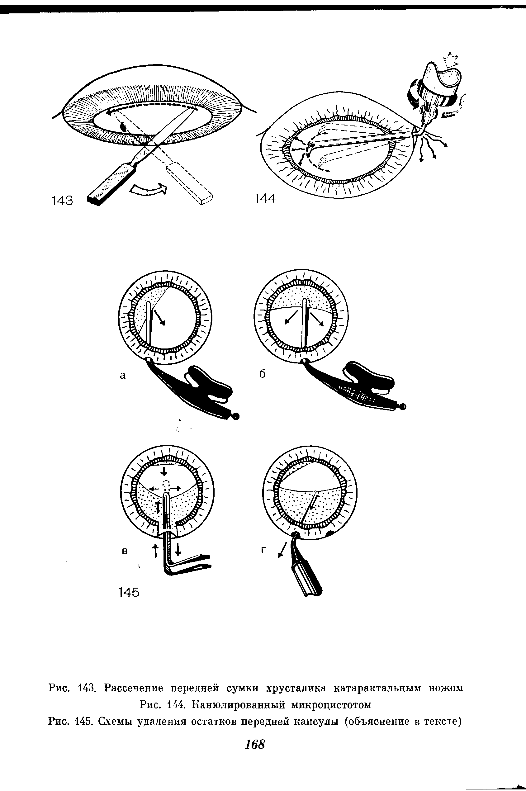 Рис. 143. Рассечение передней сумки хрусталика катарактальным ножом...