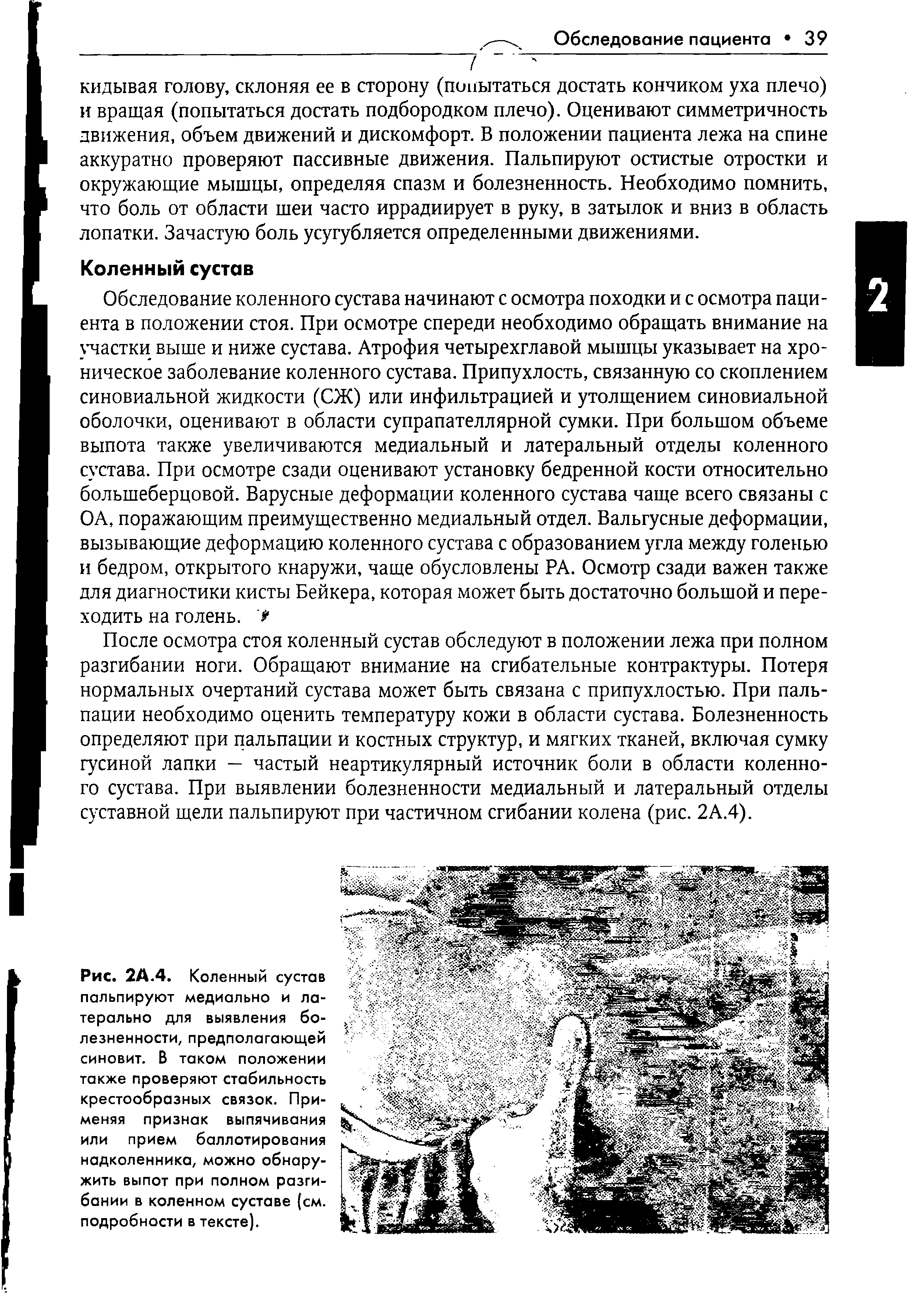 Рис. 2А.4. Коленный сустав пальпируют медиально и ла-терально для выявления болезненности, предполагающей синовит. В таком положении также проверяют стабильность крестообразных связок. Применяя признак выпячивания или прием баллотирования надколенника, можно обнаружить выпот при полном разгибании в коленном суставе (см. подробности в тексте).