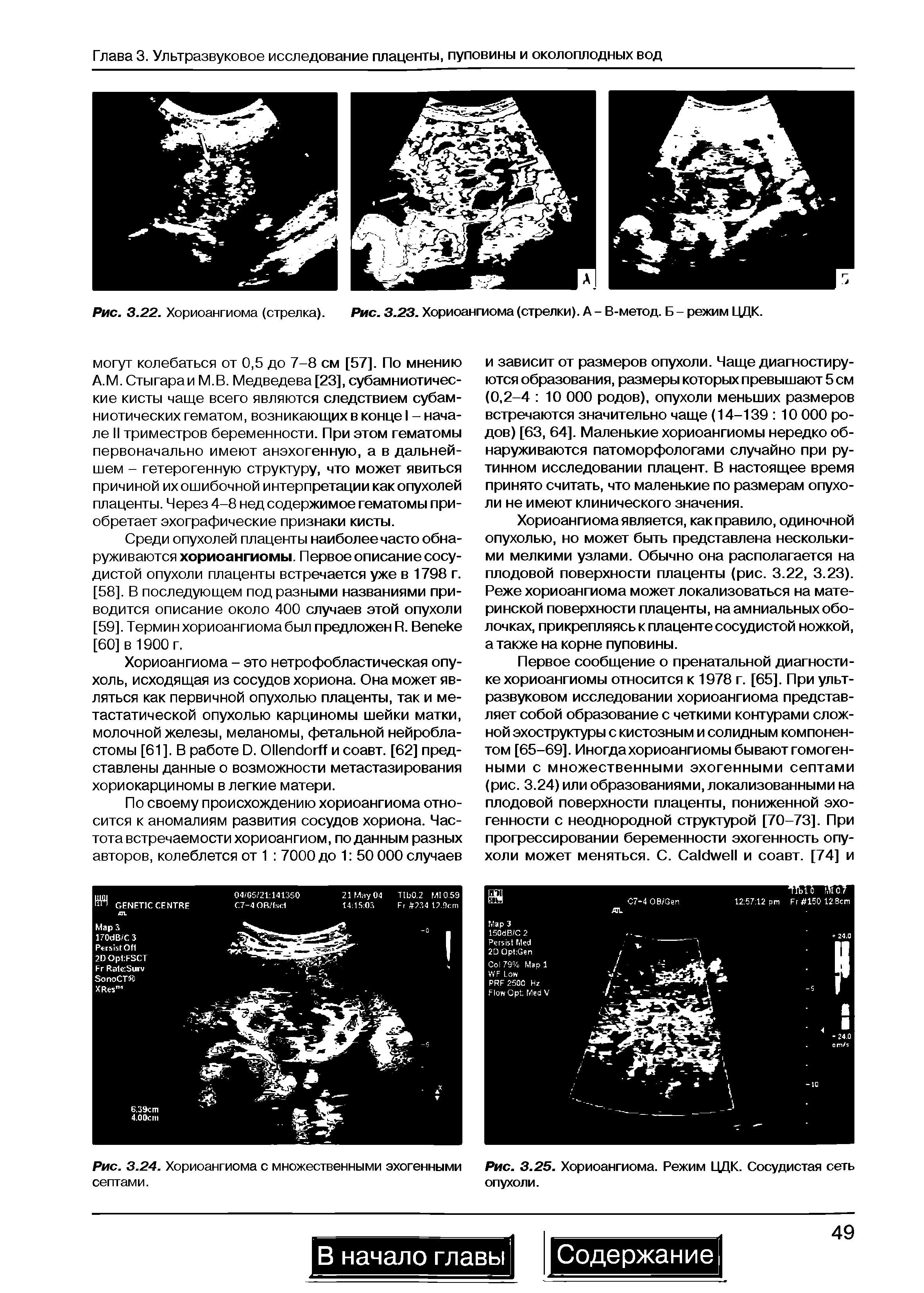 Рис. 3.22. Хориоангиома (стрелка). Рис. 3.23. Хориоангиома (стрелки). А - В-метод. Б - режим ЦДК.