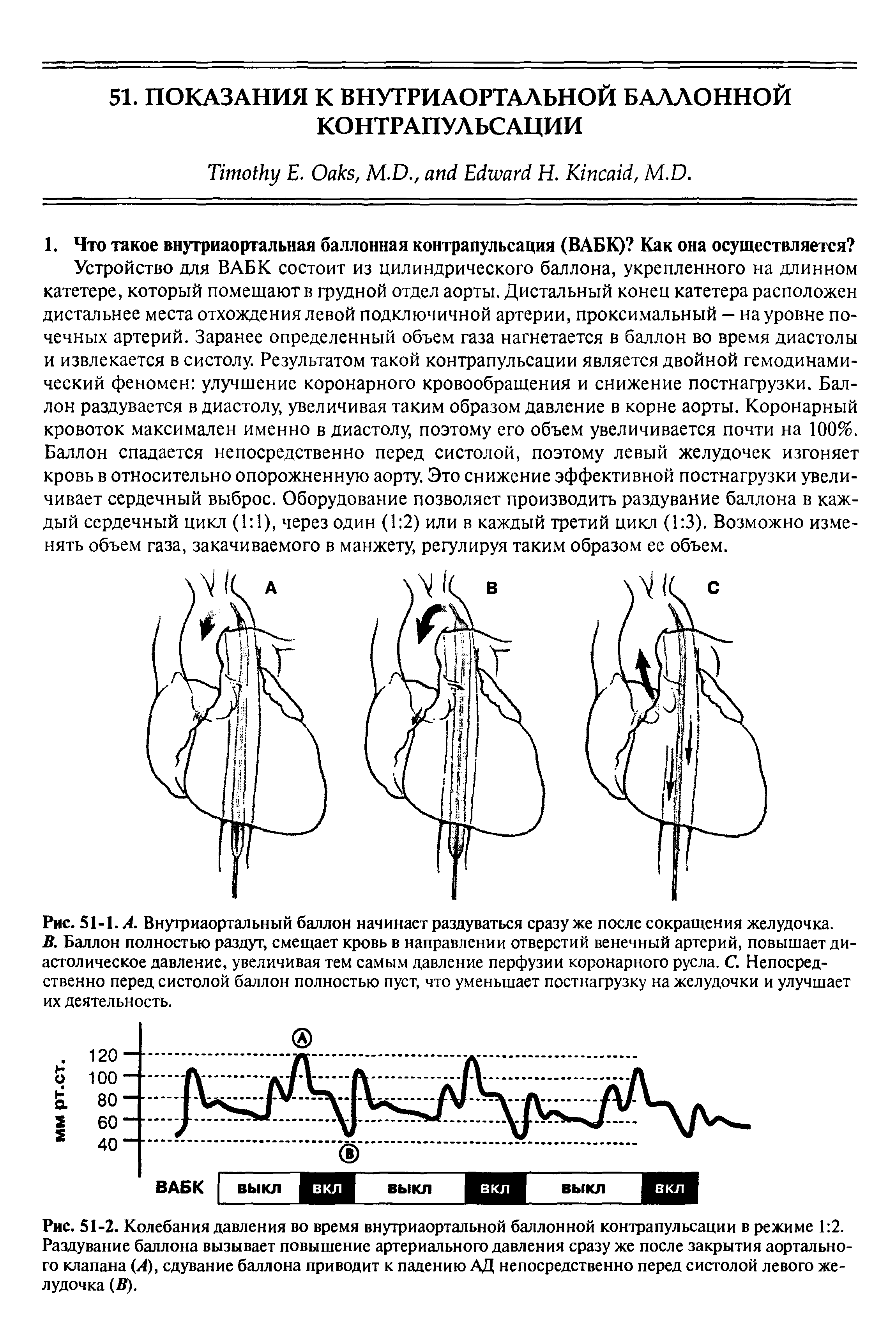 Рис. 51-2. Колебания давления во время внутриаортальной баллонной контрапульсации в режиме 1 2. Раздувание баллона вызывает повышение артериального давления сразу же после закрытия аортального клапана (А), сдувание баллона приводит к падению АД непосредственно перед систолой левого желудочка (В).