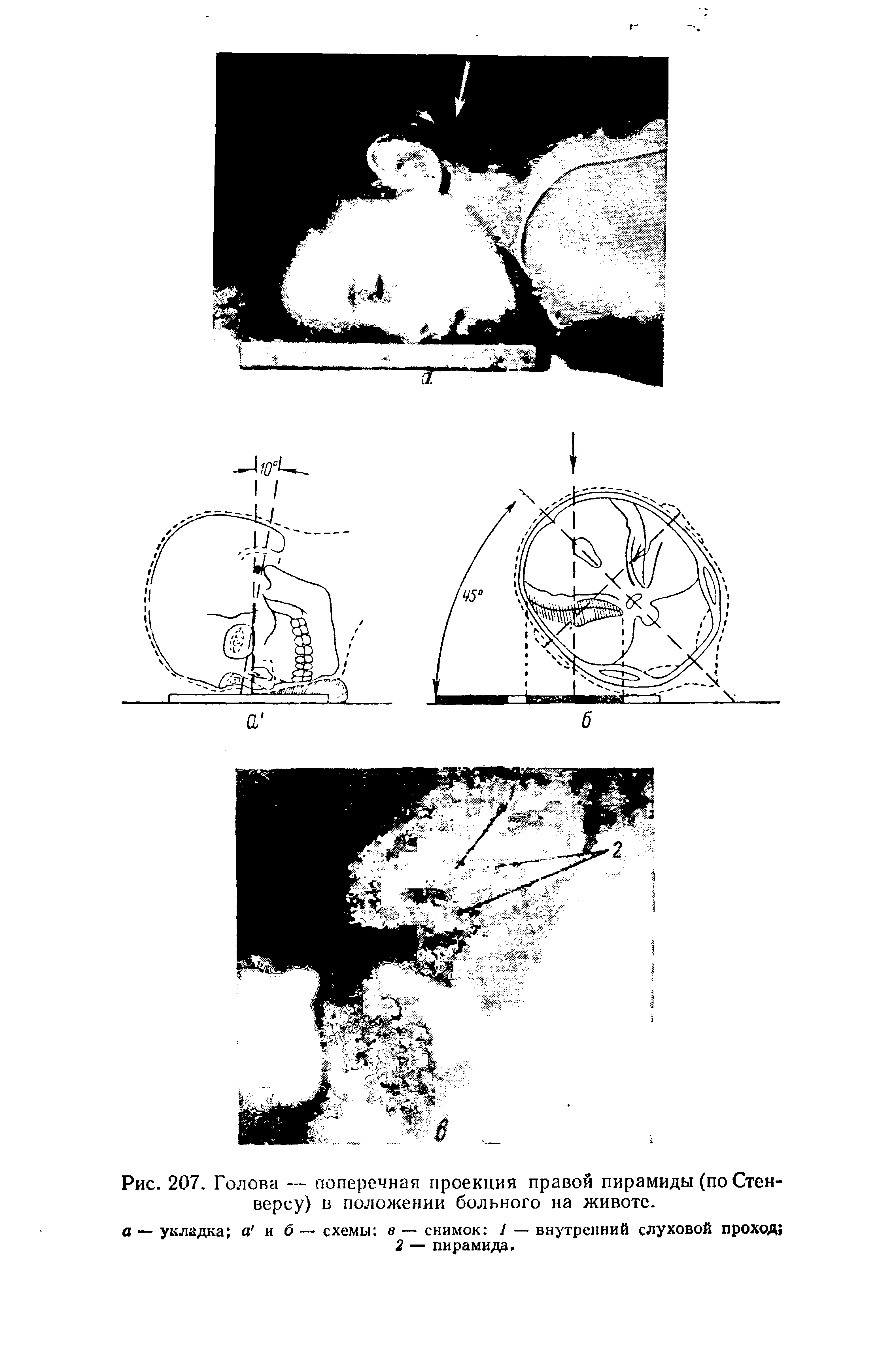 Рис. 207. Голова — поперечная проекция правой пирамиды (по Стен-версу) в положении больного на животе.