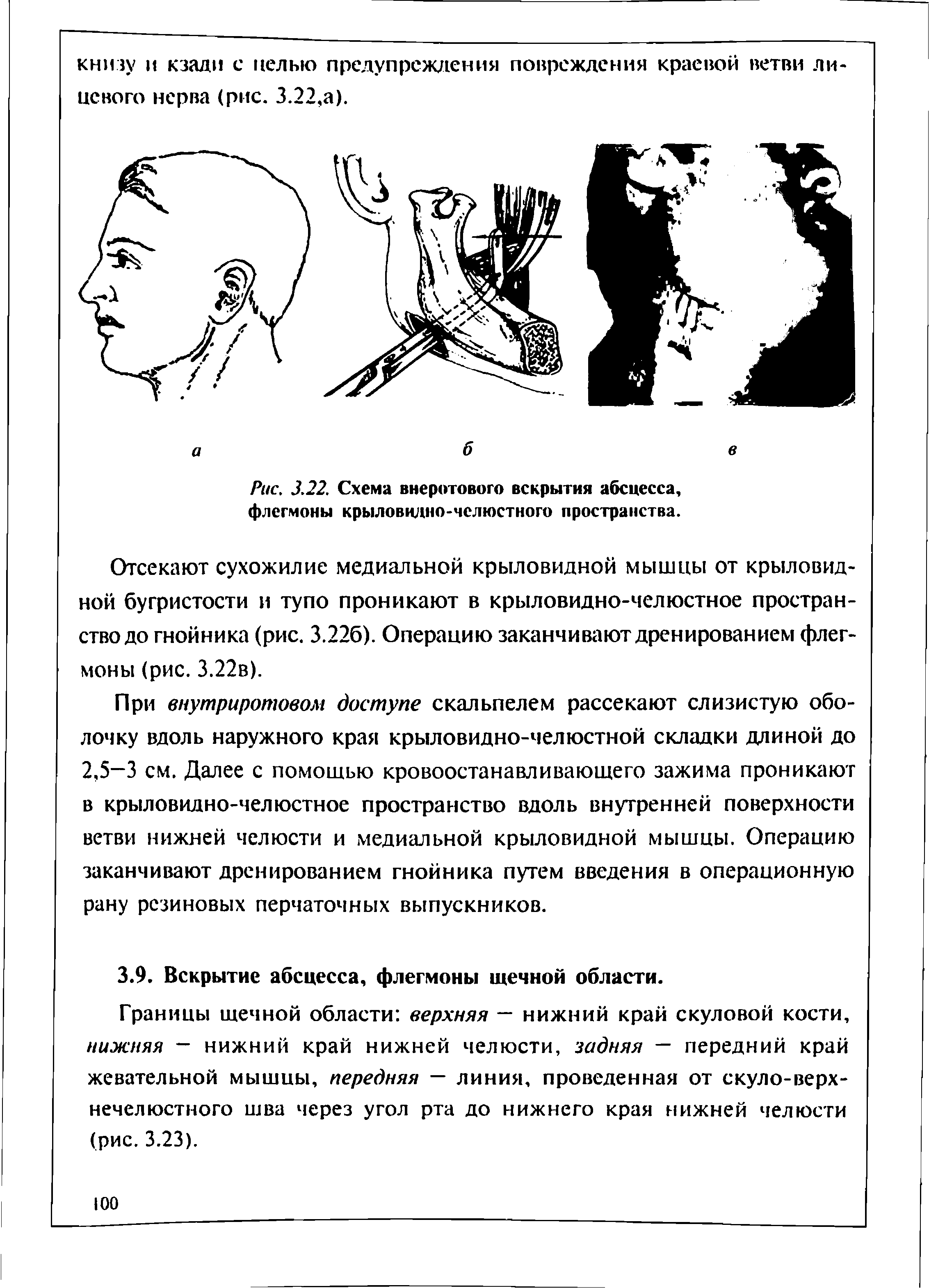 Рис. 3.22. Схема внеротового вскрытия абсцесса, флегмоны крыловидно-челюстного пространства.