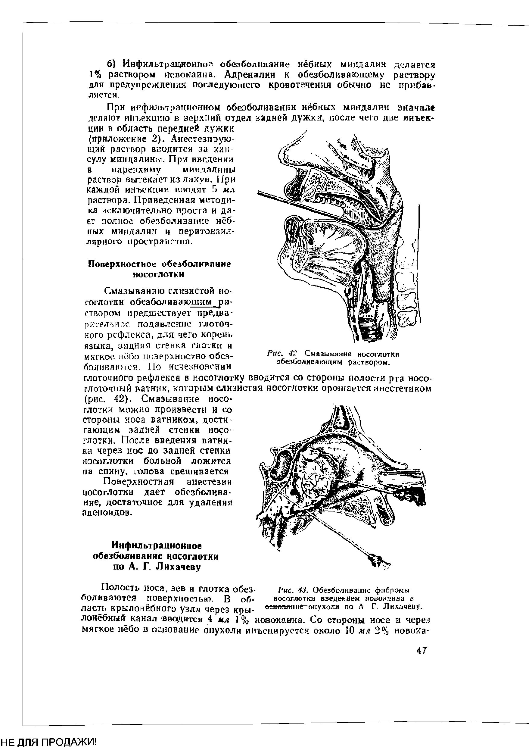 Рис. 43. Обезболивание фибромы носоглотки введением новокаина е оеновааие-опухоли по А Г. Лихачеву.