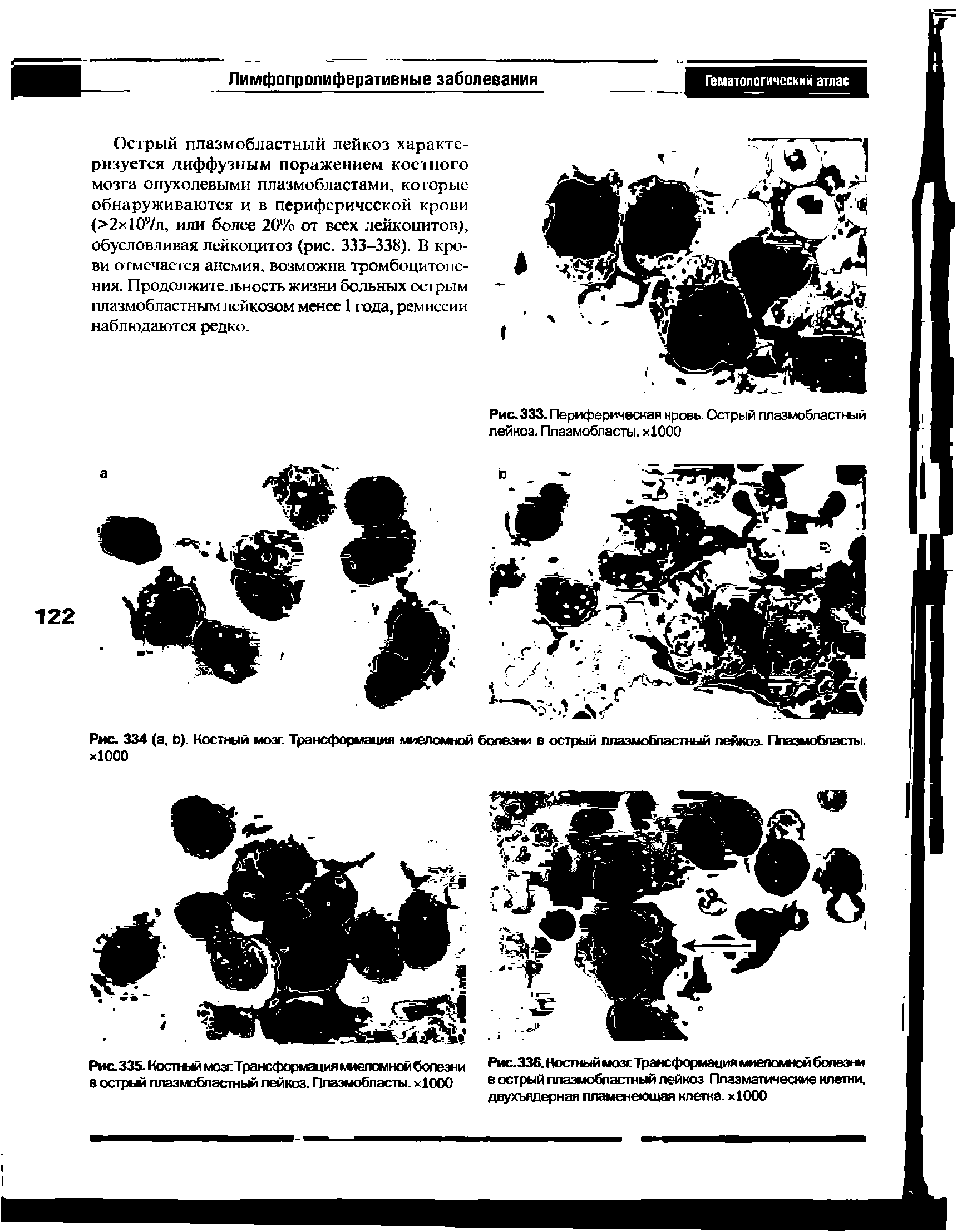 Рис.335. Костный мозг.Трансформация миеломной болезни в острьм плазмобластный лейкоз. Плазмобласты. х1000...