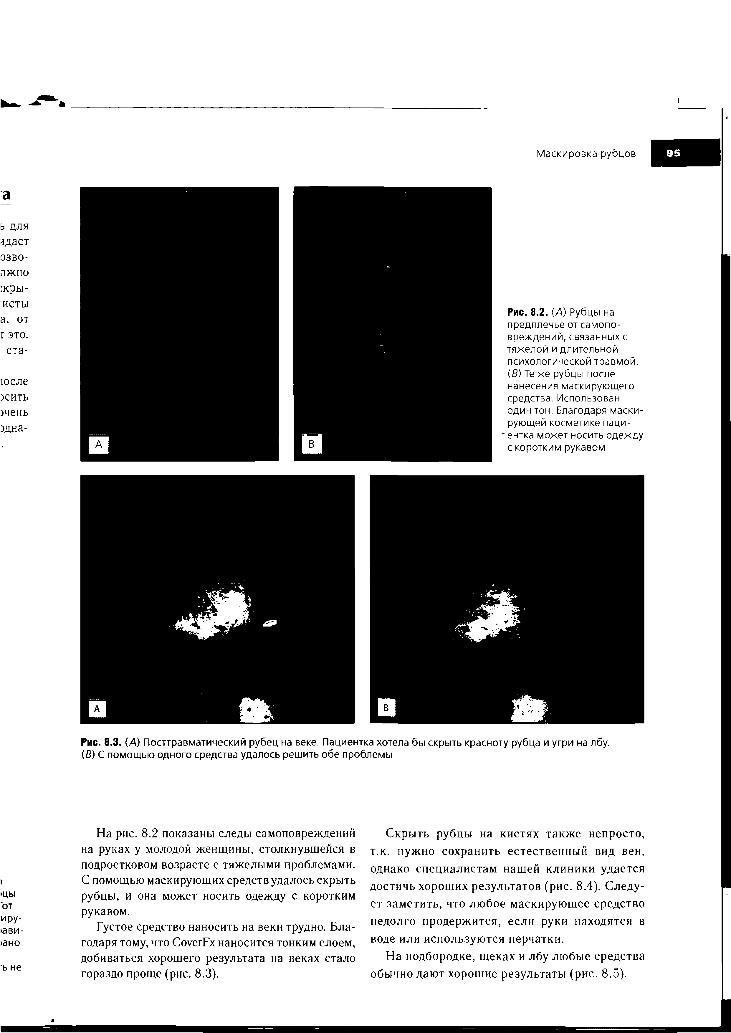 Рис. 8.2. (А) Рубцы на предплечье от самопо-вреждений, связанных с тяжелой и длительной психологической травмой. (В) Те же рубцы после нанесения маскирующего средства. Использован один тон. Благодаря маскирующей косметике паци-ентка может носить одежду с коротким рукавом...