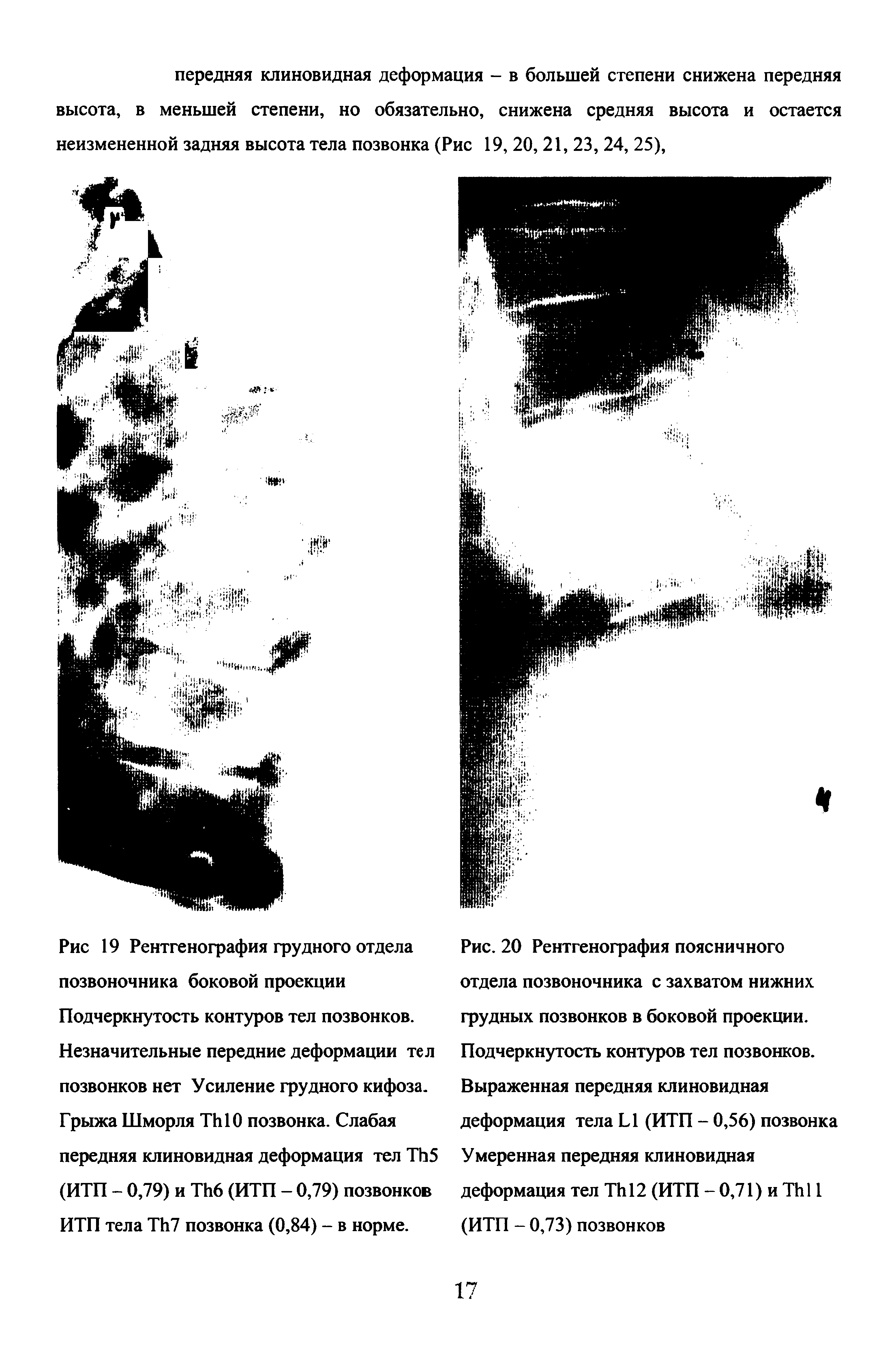 Рис. 20 Рентгенография поясничного отдела позвоночника с захватом нижних грудных позвонков в боковой проекции. Подчеркнутость контуров тел позвонков. Выраженная передняя клиновидная деформация тела Ы (ИТП - 0,56) позвонка Умеренная передняя клиновидная деформация тел ТЫ 2 (ИТП - 0,71) и ТЫ 1 (ИТП - 0,73) позвонков...