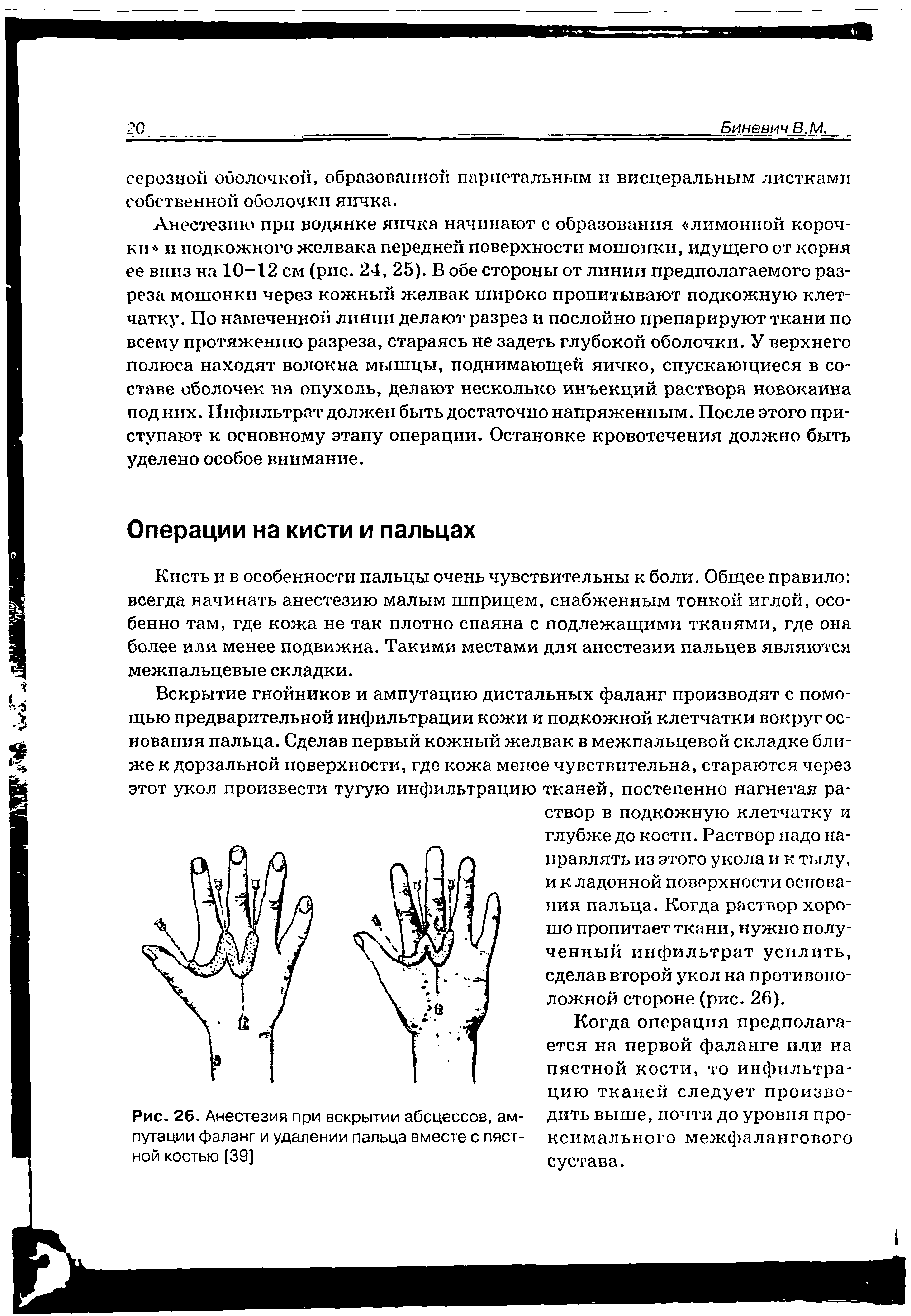 Рис. 26. Анестезия при вскрытии абсцессов, ампутации фаланг и удалении пальца вместе с пястной костью [39]...