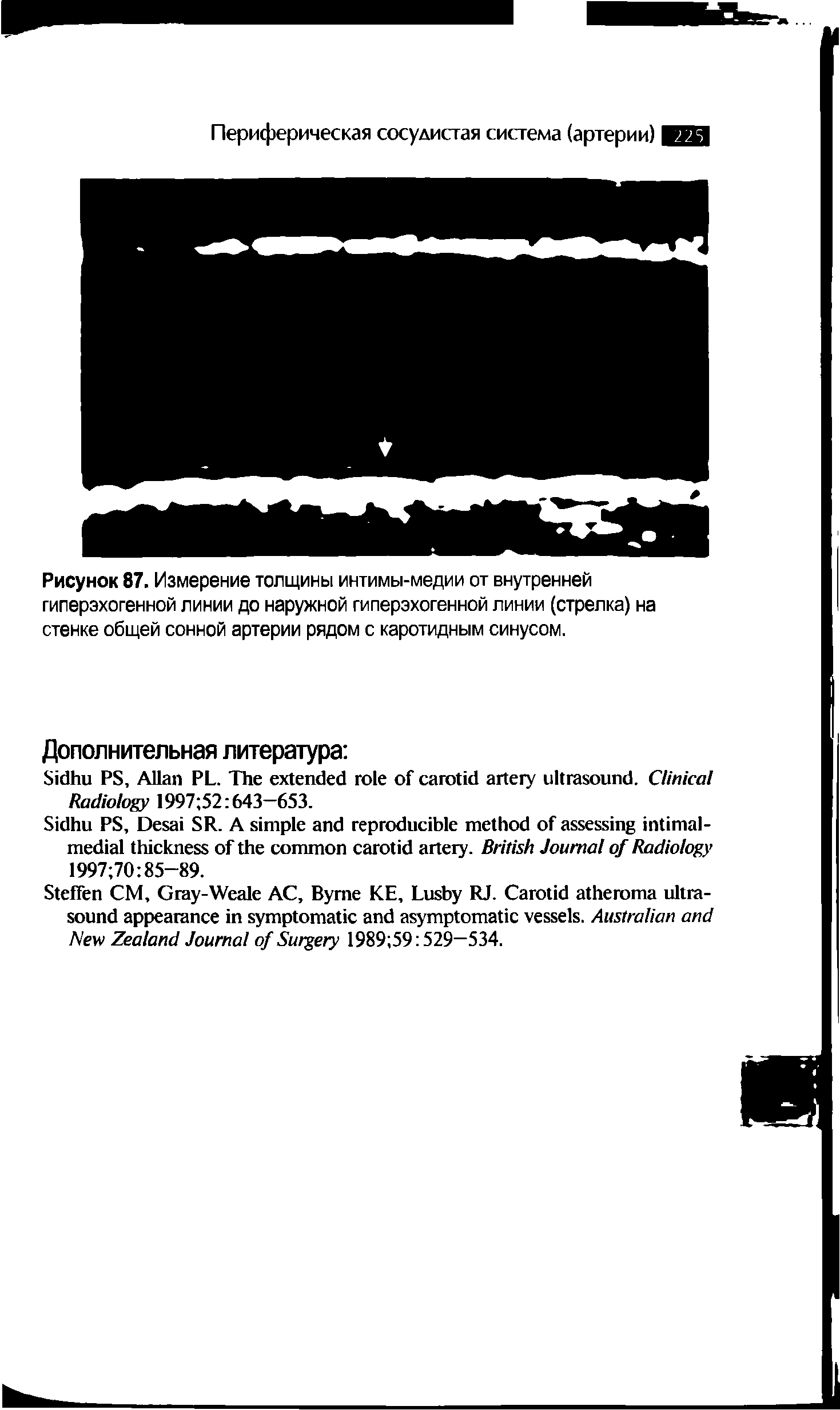 Рисунок 87. Измерение толщины интимы-медии от внутренней гиперэхогенной линии до наружной гиперэхогенной линии (стрелка) на стенке общей сонной артерии рядом с каротидным синусом.