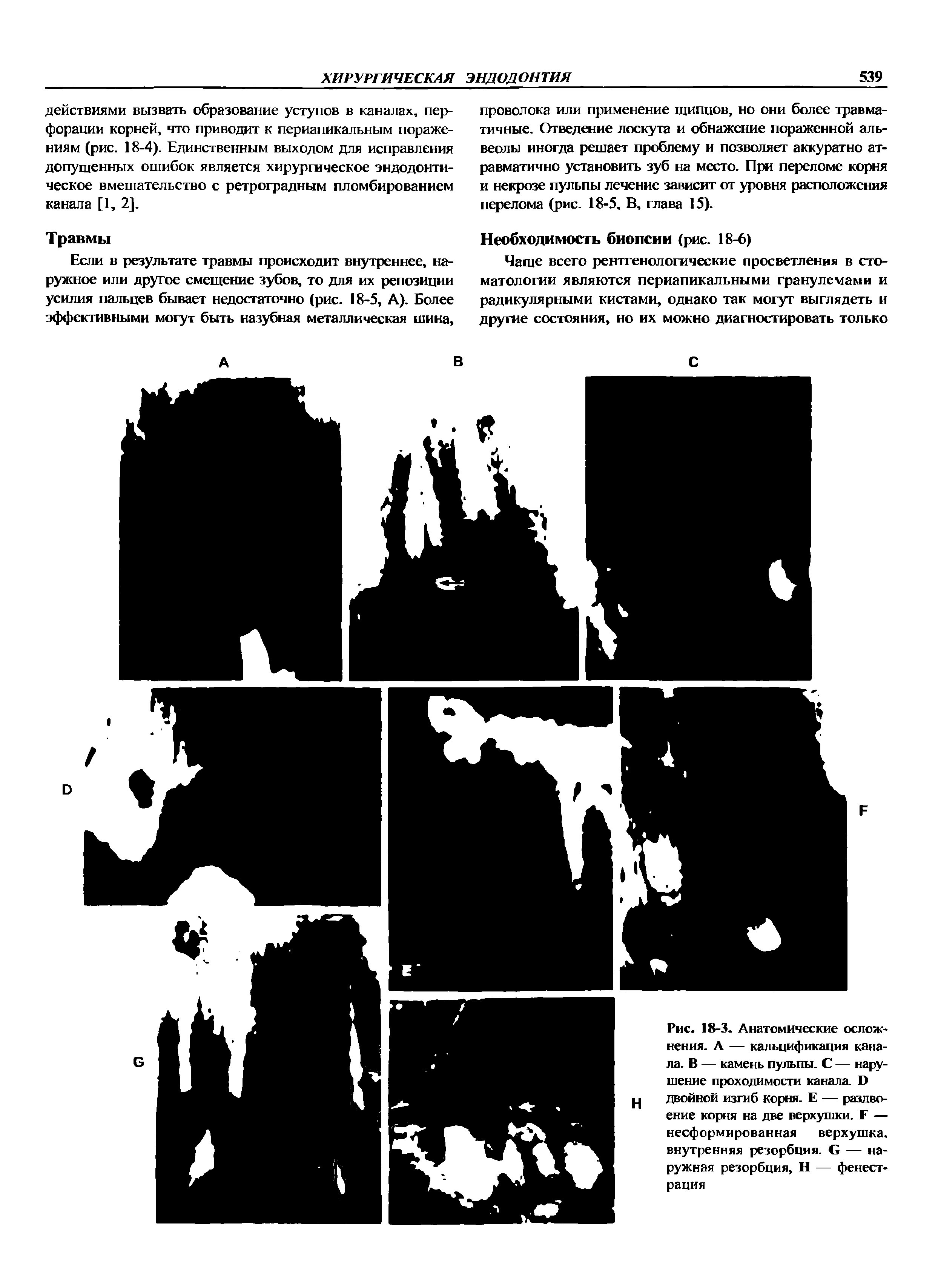 Рис. 18-3. Анатомические осложнения. А — кальцификация канала. В — камень пульпы. С — нарушение проходимости канала. Б двойной изгиб корня. Е — раздвоение корня на две верхушки. Е — несформированная верхушка, внутренняя резорбция, в — наружная резорбция, Н — фенестрация...