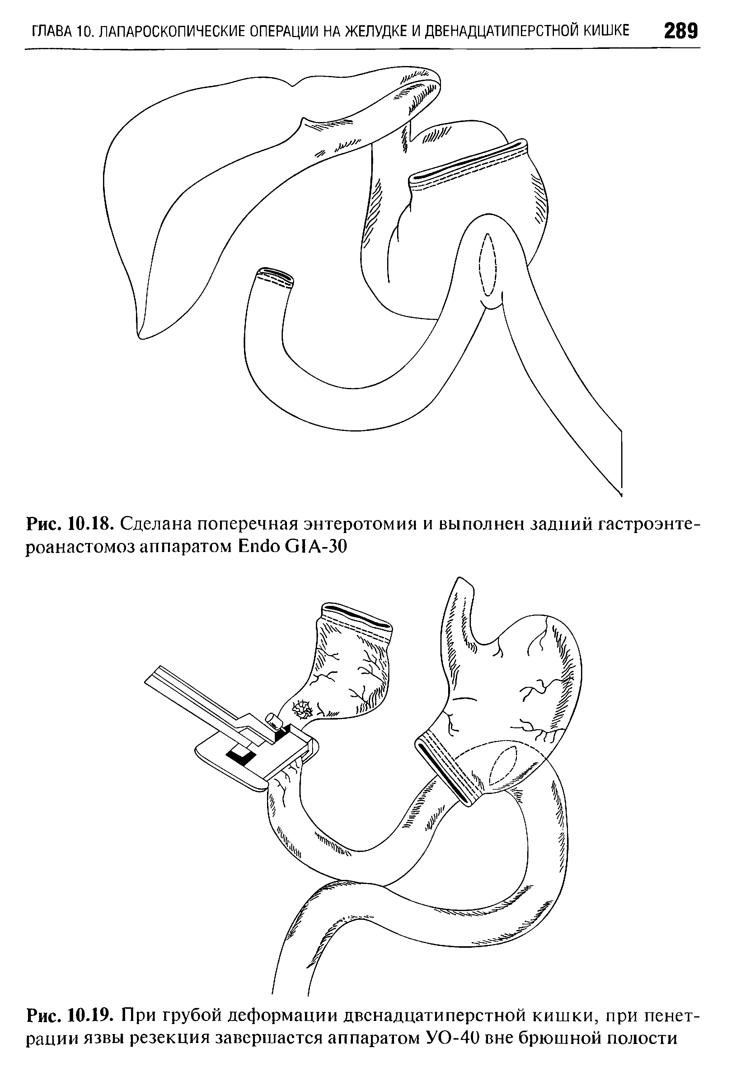 Рис. 10.19. При грубой деформации двенадцатиперстной кишки, при пенет-рации язвы резекция завершается аппаратом УО-40 вне брюшной полости...
