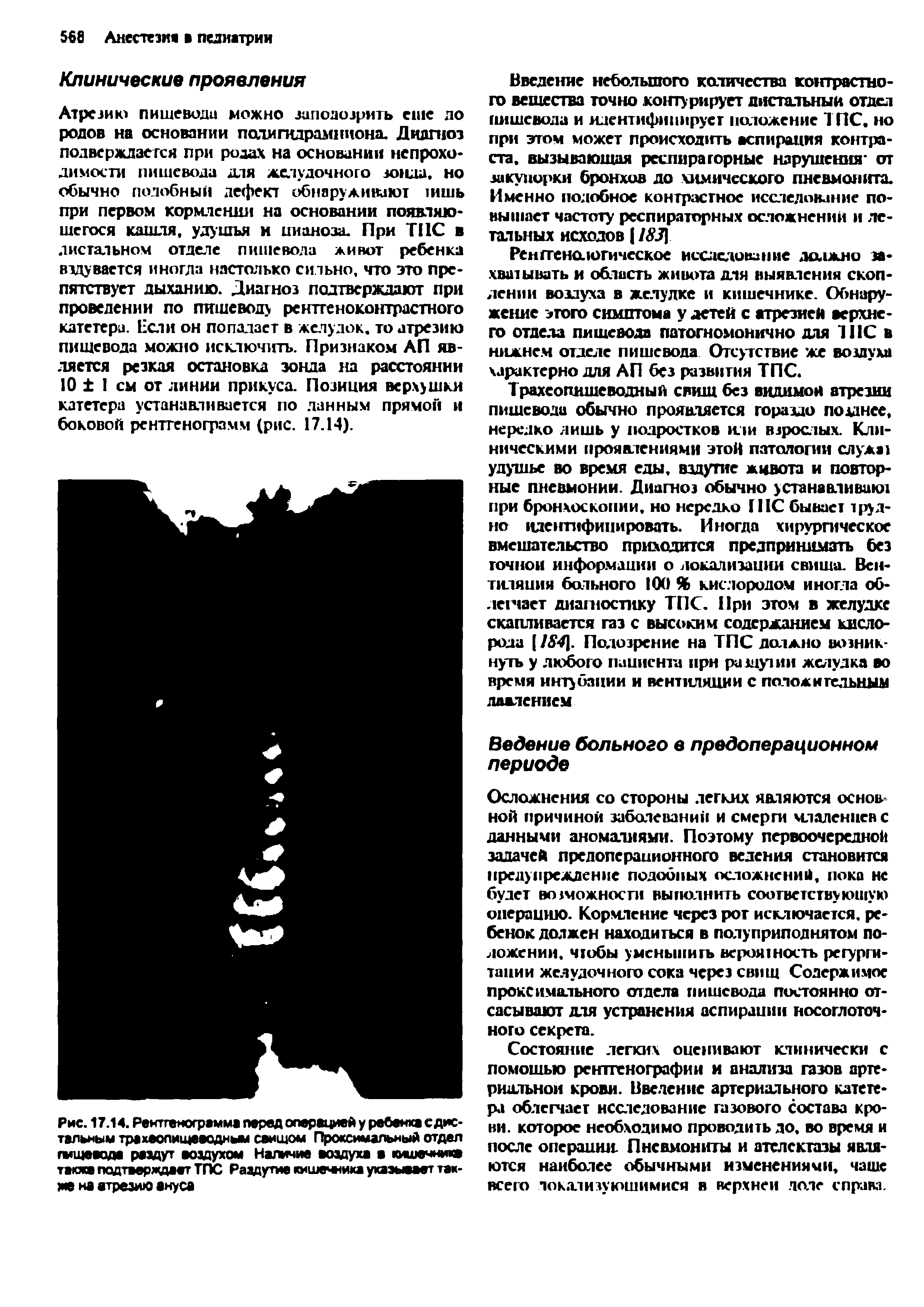 Рис. 17.14. Рентгенограмма перед операцией у ребенка с дистальным трахеопищеводным свищом Проксимальный отдел гмщеоода раздут воздухом Наличие воздуха а кишечника также подтверждает ТПС Раздутие кмше ика указывает такие на атрезию ануса...