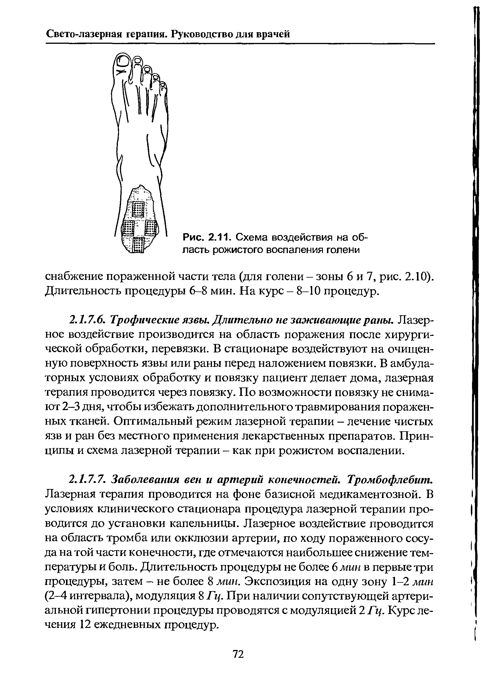 Рис. 2.11. Схема воздействия на область рожистого воспаления голени...