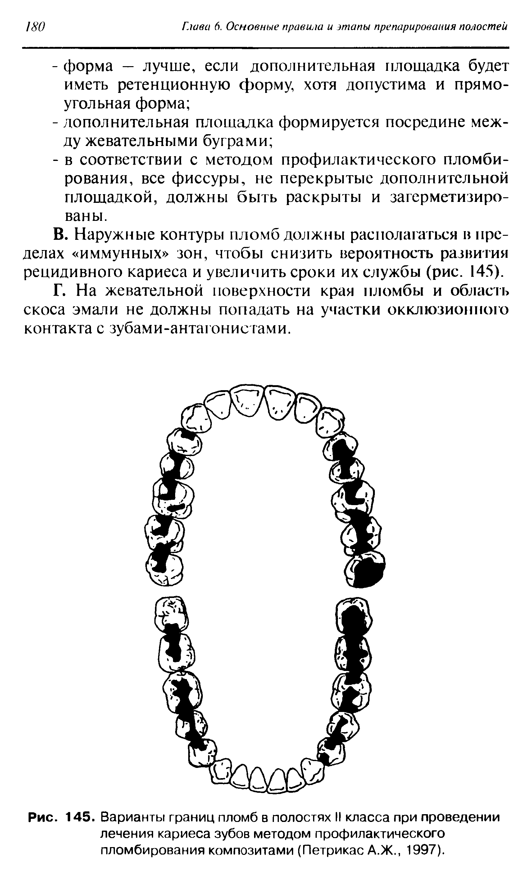 Рис. 145. Варианты границ пломб в полостях II класса при проведении лечения кариеса зубов методом профилактического пломбирования композитами (Петрикас А.Ж., 1997).