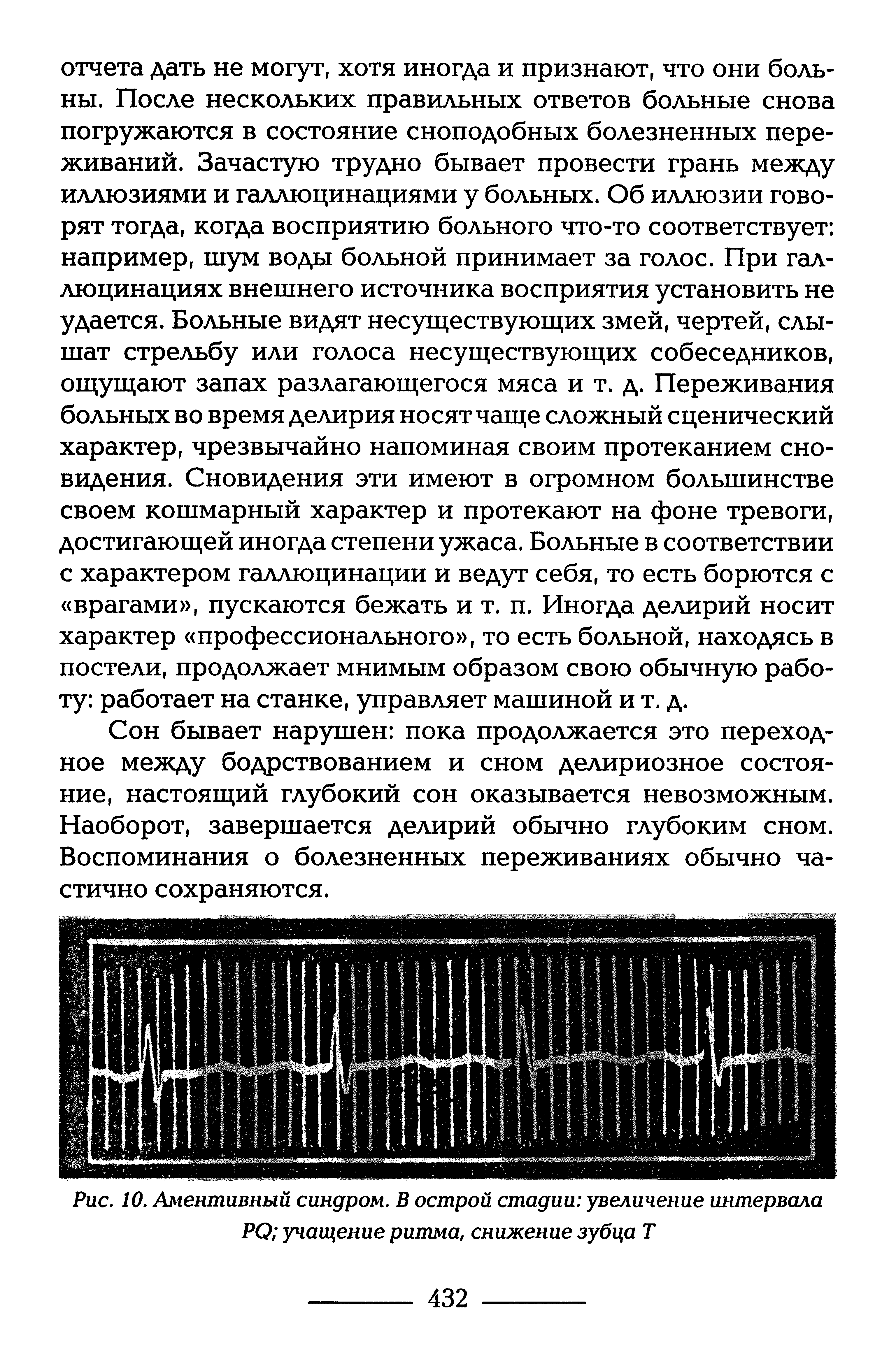 Рис. 10. Аментивный синдром. В острой стадии увеличение интервала...