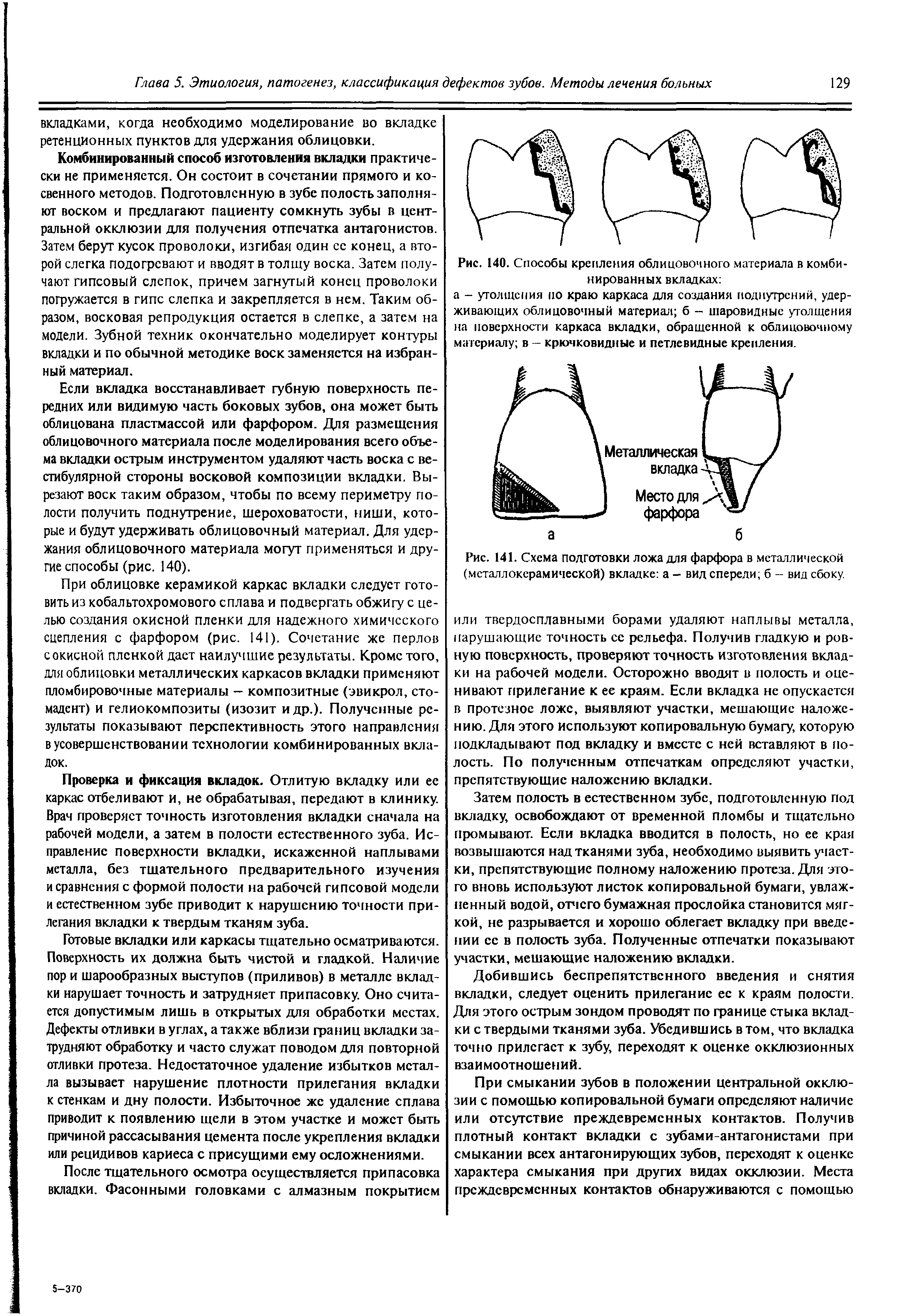 Рис. 141. Схема подготовки ложа для фарфора в металлической (металлокерамической) вкладке а - вид спереди б - вид сбоку.