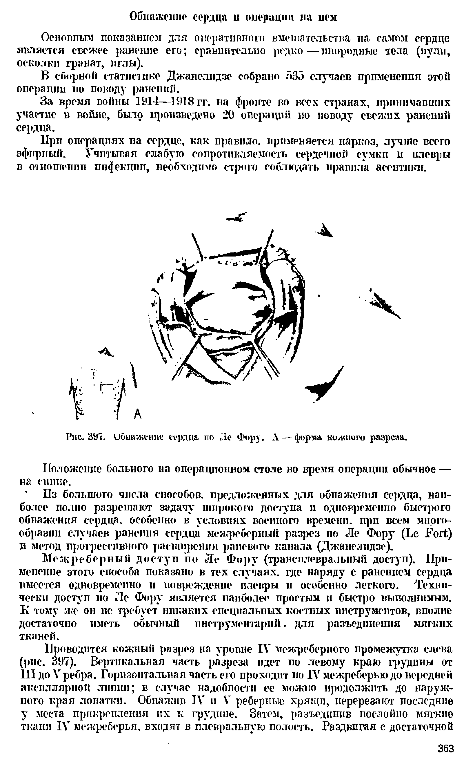 Рис. 397. Обнажение сердца по Де Фиру. А — форма кожного разреза.