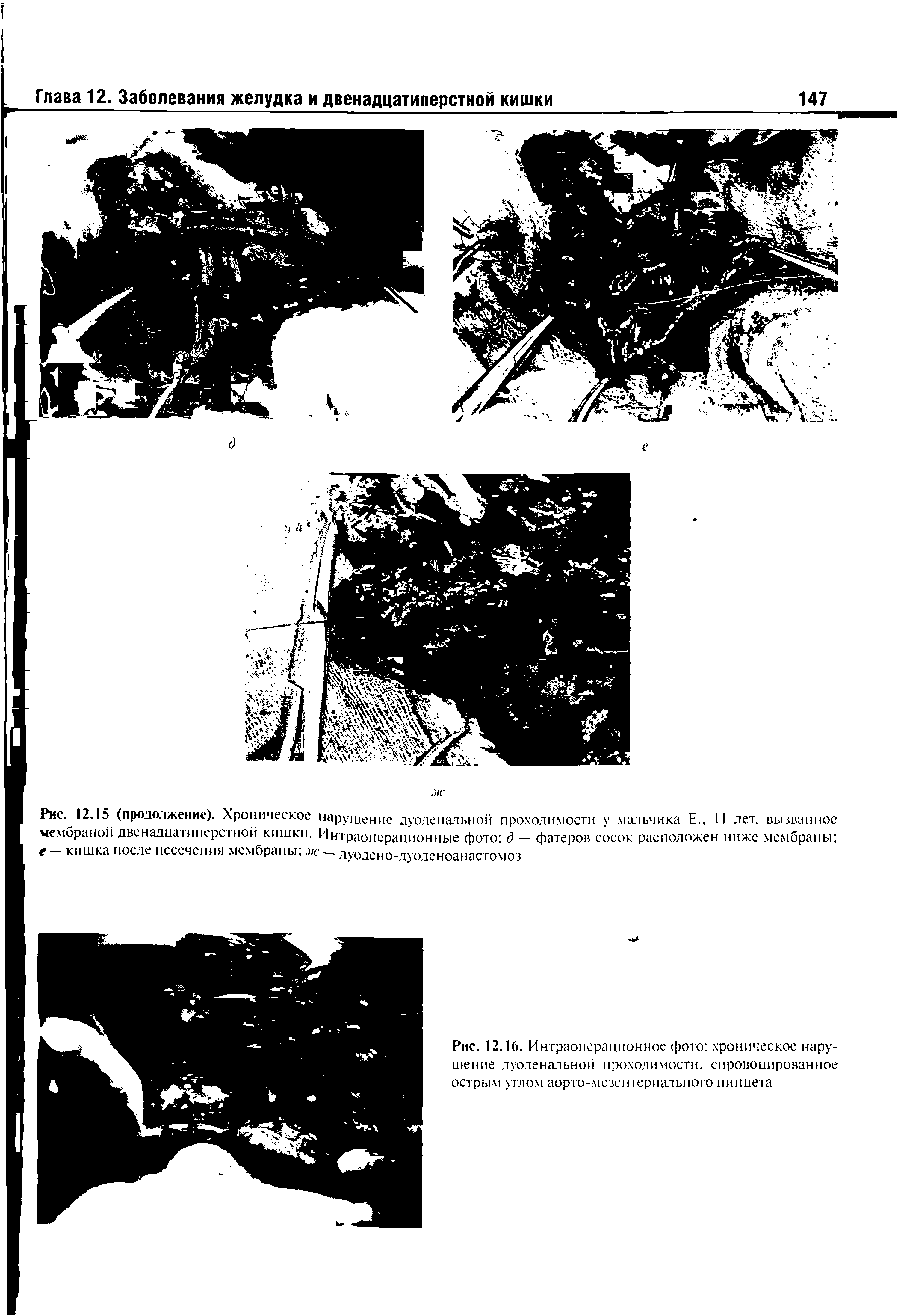 Рис. 12.16. Интраоперационное фото хроническое нарушение дуоденальной проходимости, спровоцированное острым углом аорто-мезентериалыюго пинцета...