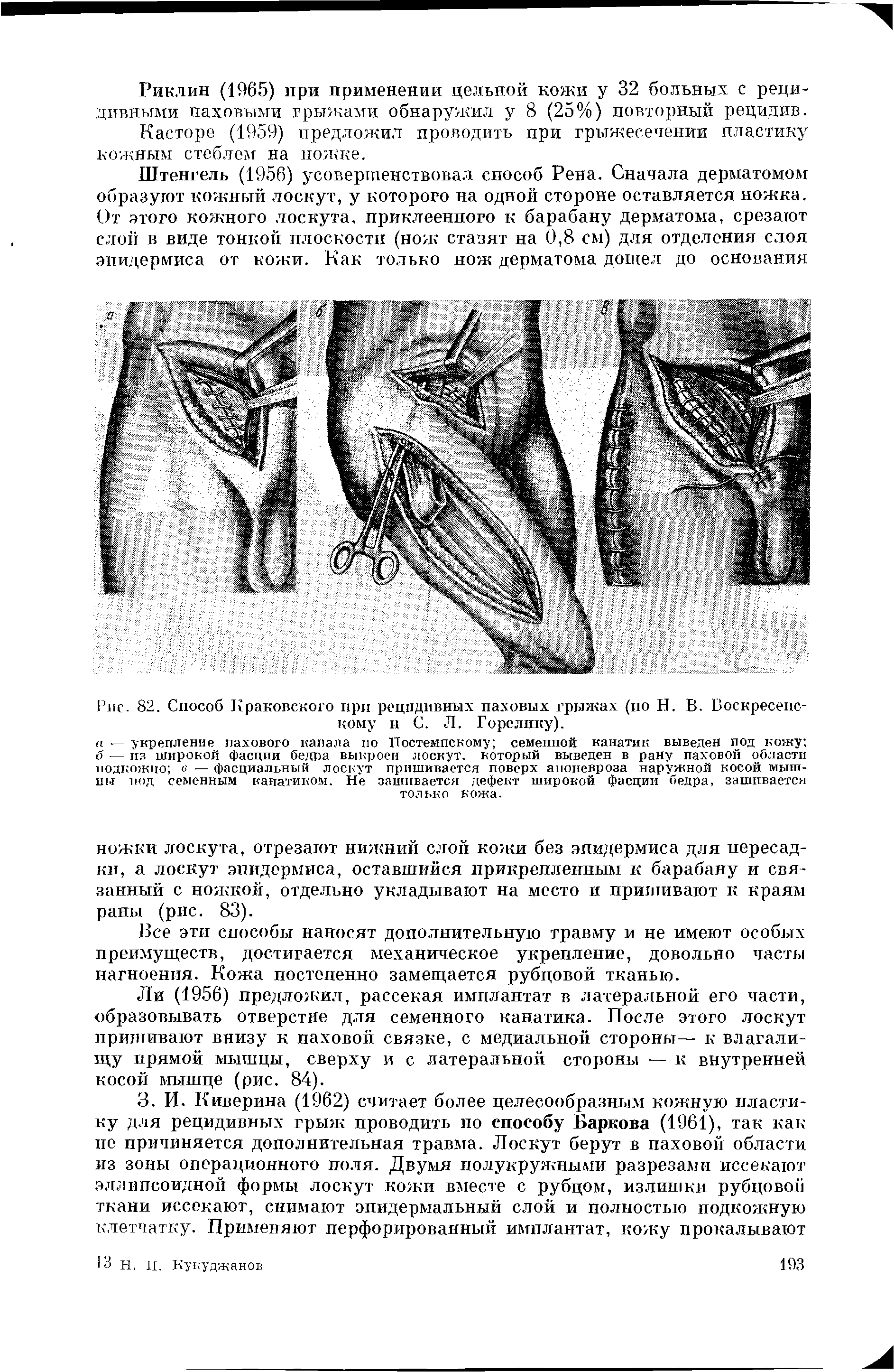 Рис. 82. Способ Краковского при рецидивных паховых грыжах (по Н. В. Воскресенскому и С. Л. Горелику).