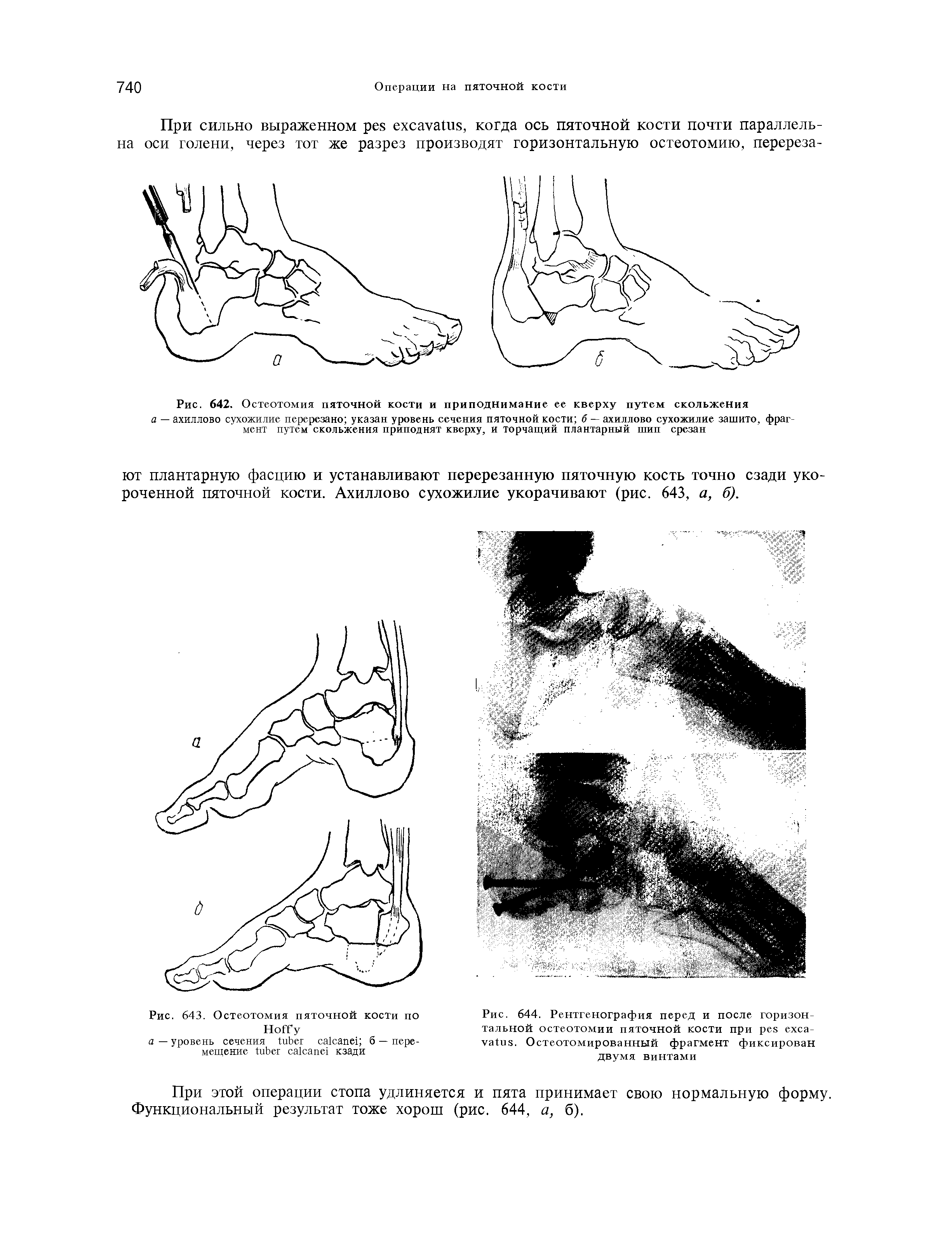 Рис. 644. Рентгенография перед и после горизонтальной остеотомии пяточной кости при . Остеотомированный фрагмент фиксирован двумя винтами...