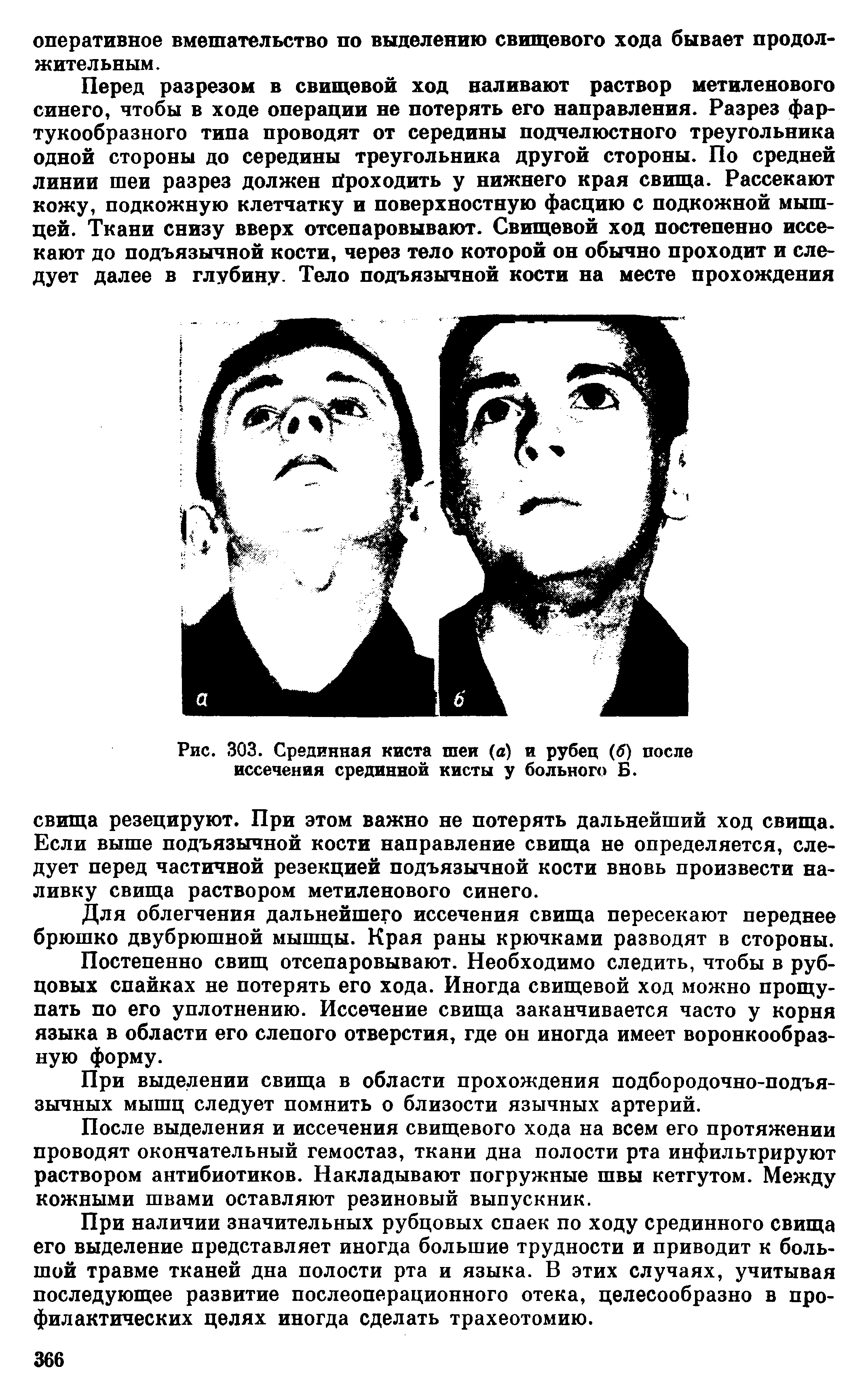 Рис. 303. Срединная киста шеи (а) и рубец (б) после иссечения срединной кисты у больного Б.