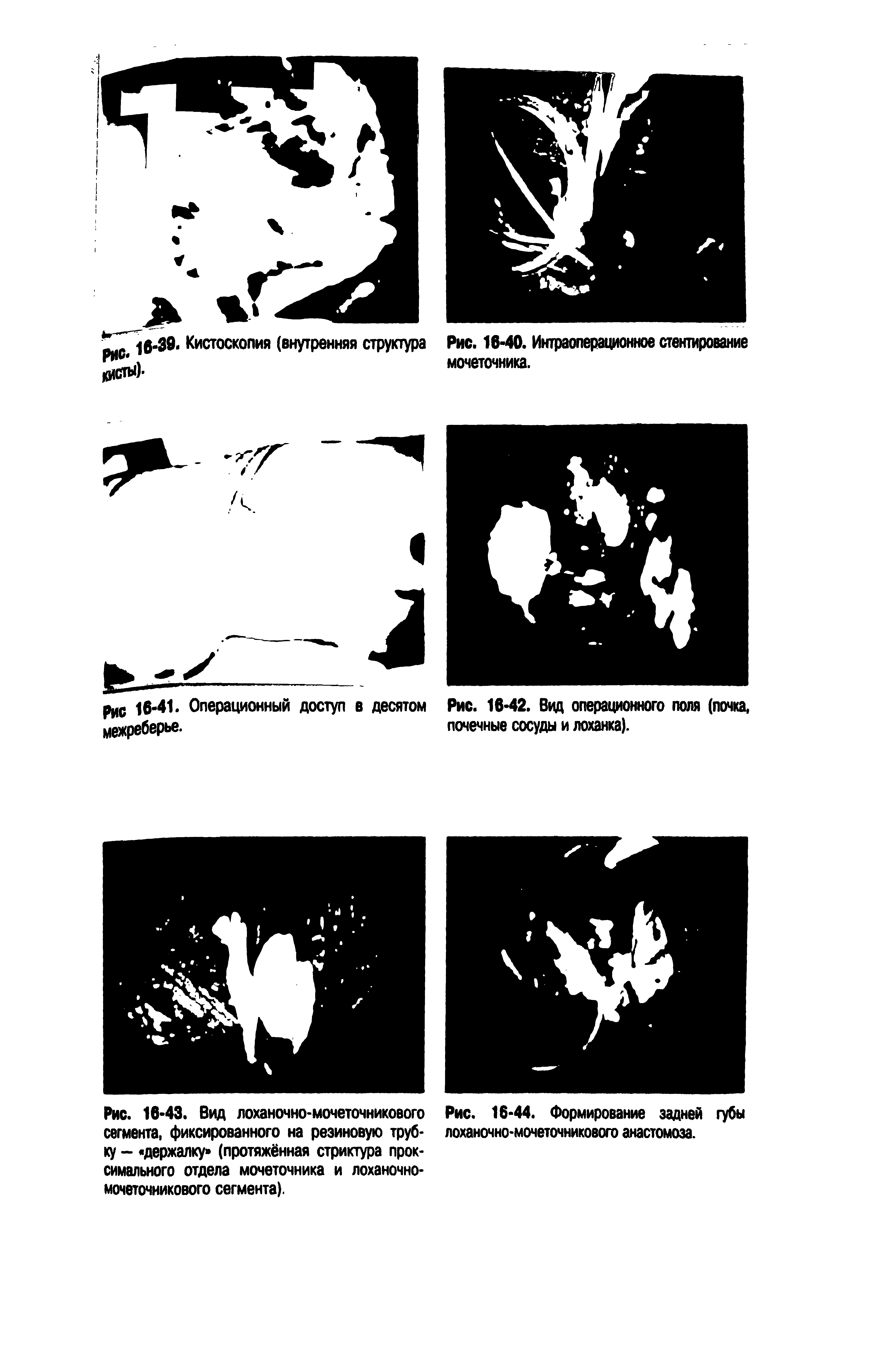 Рис. 16-43. Вид лоханочно-мочеточникового Рис. 16-44. Формирование задней губы сегмента, фиксированного на резиновую труб- лоханочно-мочеточникового анастомоза, ку - держалку (протяжённая стриктура проксимального отдела мочеточника и лоханочно-мочеточникового сегмента).