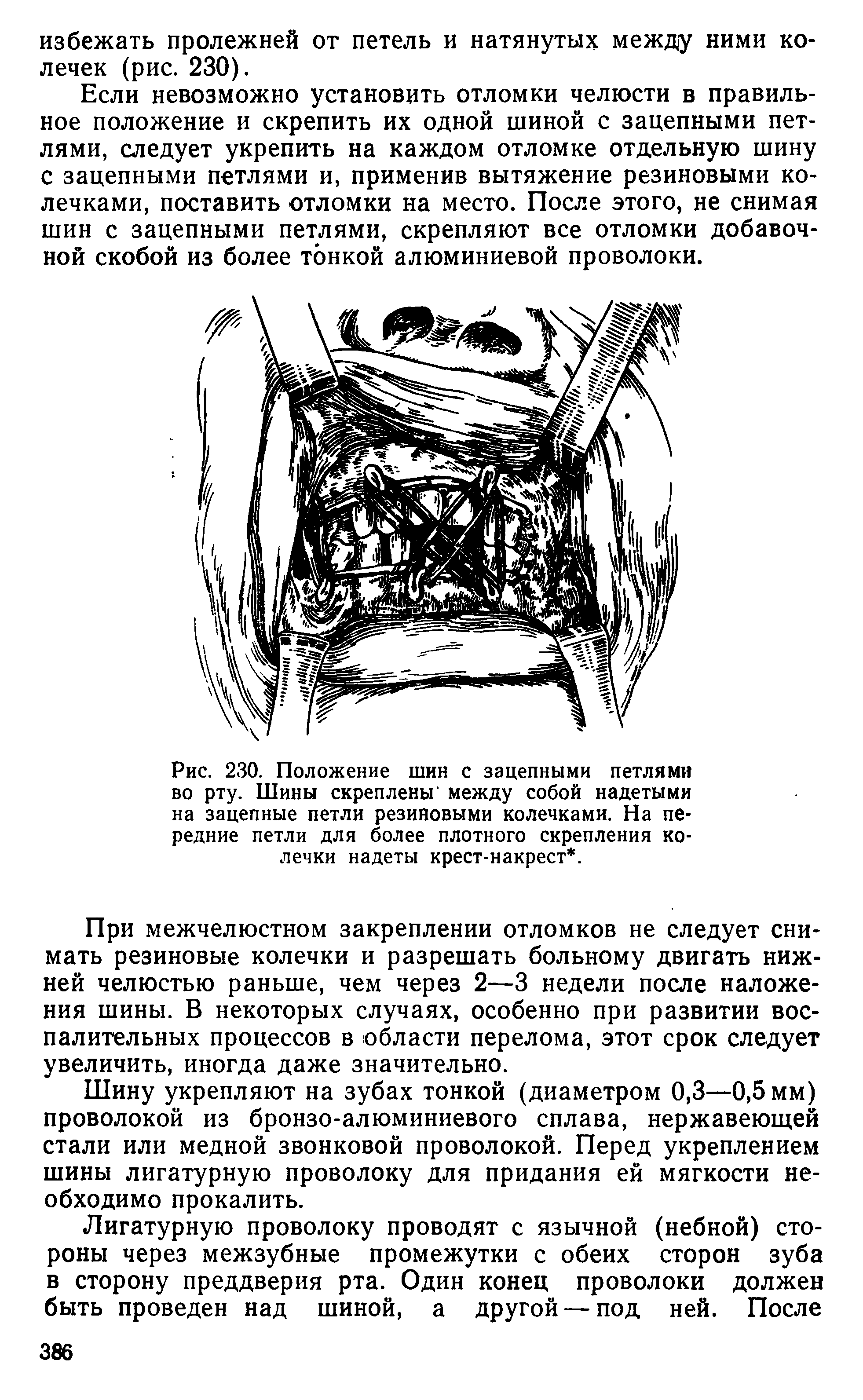 Рис. 230. Положение шин с зацепными петлями во рту. Шины скреплены между собой надетыми на зацепные петли резиновыми колечками. На передние петли для более плотного скрепления колечки надеты крест-накрест. ...