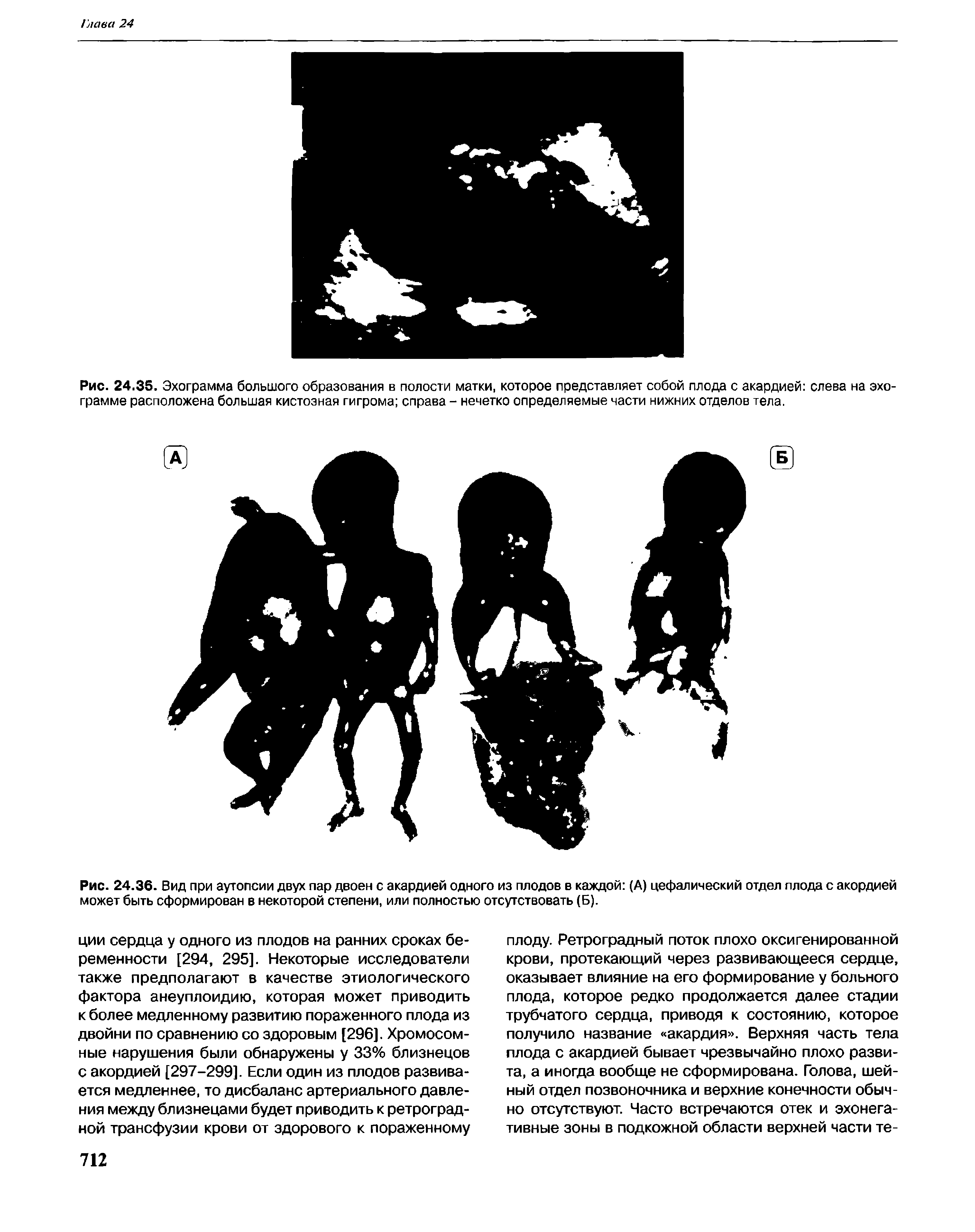 Рис. 24.36. Вид при аутопсии двух пар двоен с акардией одного из плодов в каждой (А) цефалический отдел плода с акордией может быть сформирован в некоторой степени, или полностью отсутствовать (Б).
