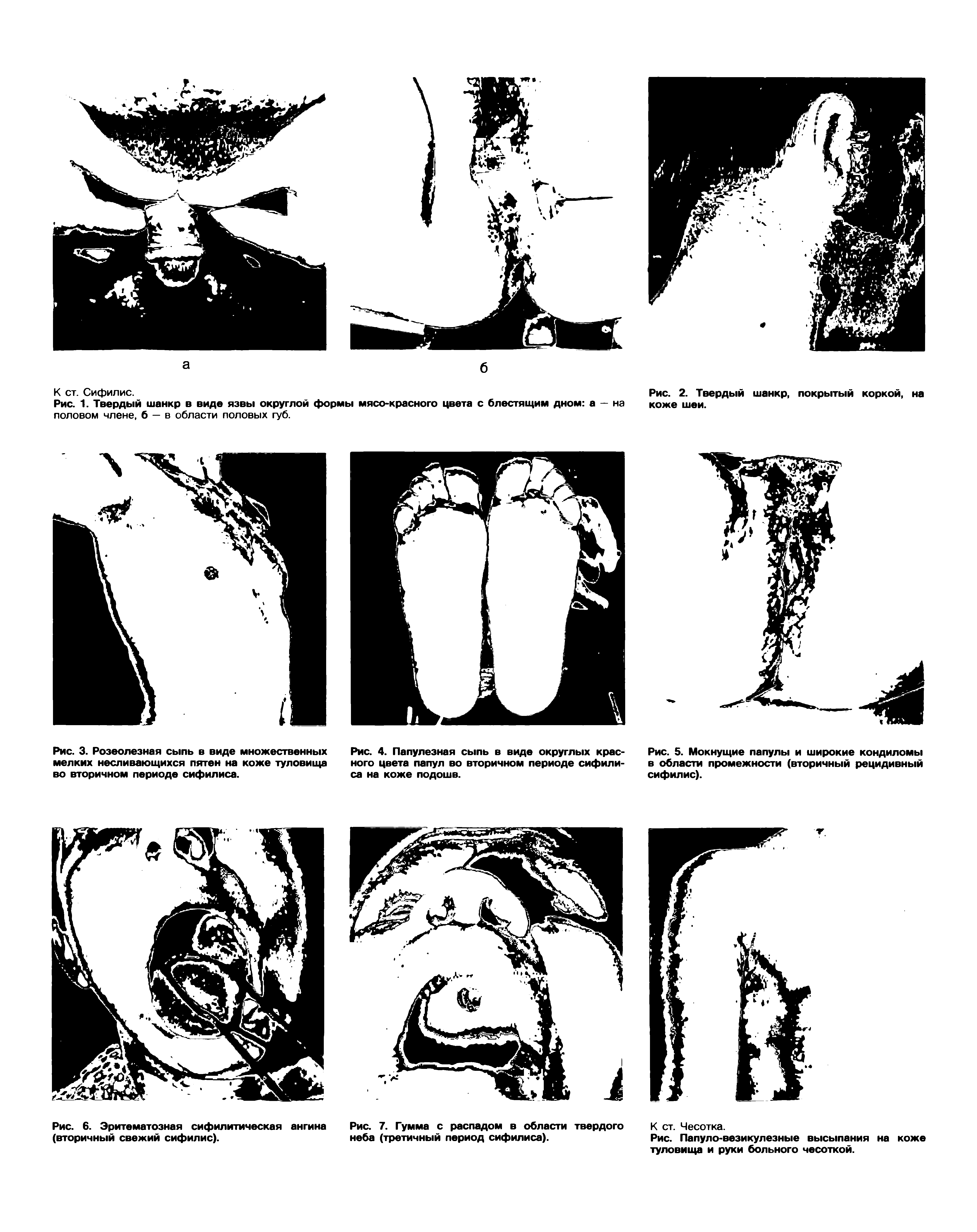 Рис. 5. Мокнущие папулы и широкие кондиломы в области промежности (вторичный рецидивный сифилис).