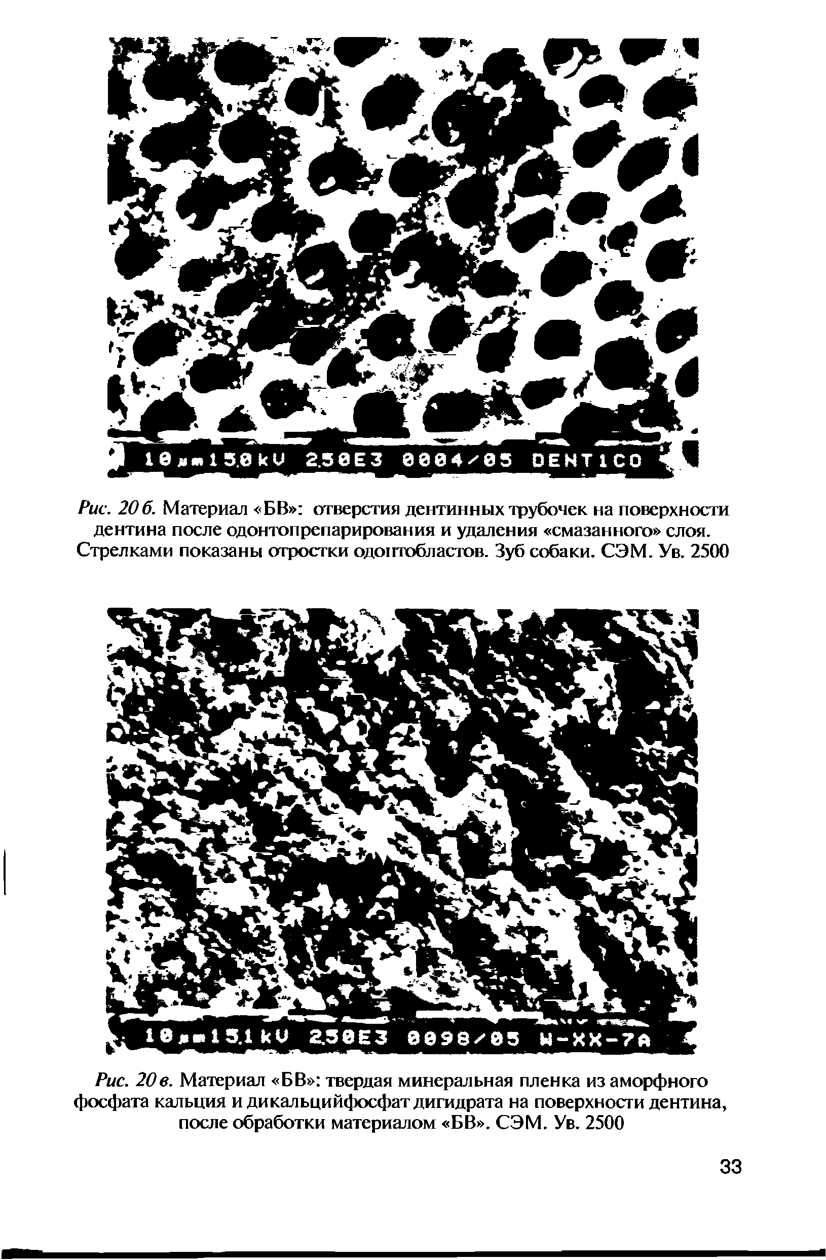 Рис. 20в. Материал БВ твердая минеральная пленка из аморфного фосфата кальция и дикальцийфосфат дигидрата на поверхности дентина, после обработки материалом БВ . СЭМ. Ув. 2500...