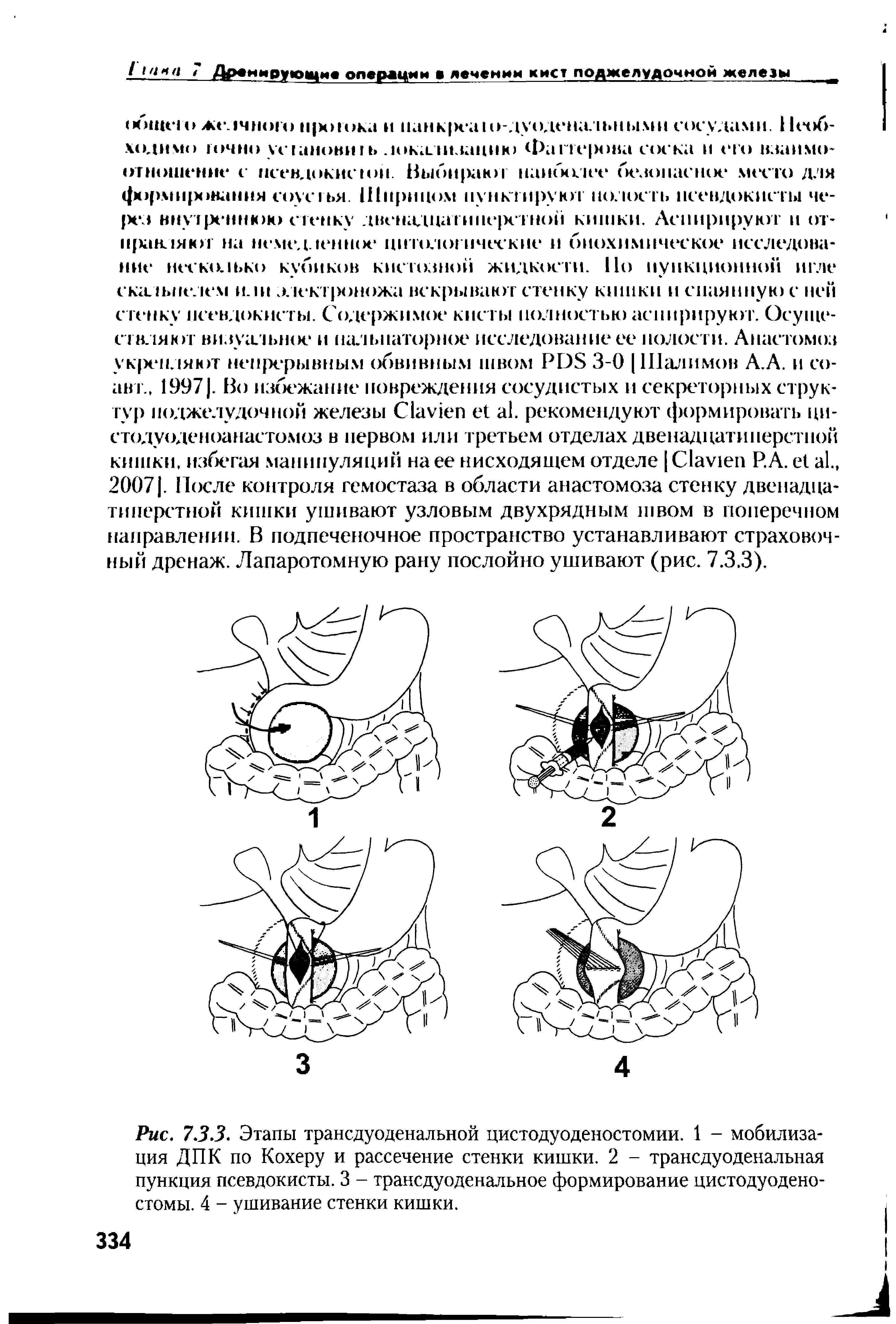 Рис. 733. Этапы трансдуоденальной цистодуоденостомии. 1 - мобилизация ДПК по Кохеру и рассечение стенки кишки. 2 - трансдуоденальная пункция псевдокисты. 3 - трансдуоденальное формирование цистодуодено-стомы. 4 - ушивание стенки кишки.
