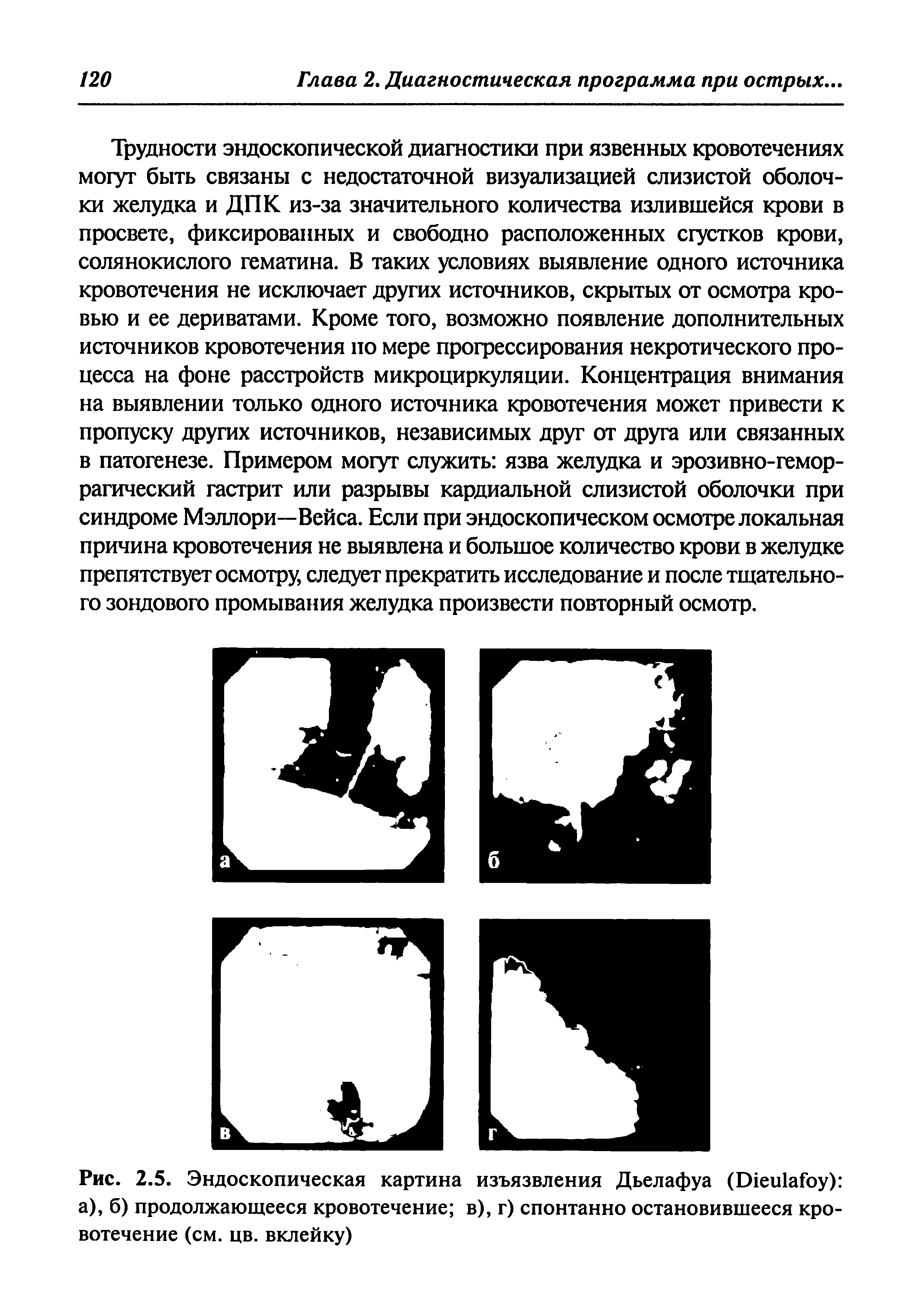 Рис. 2.5. Эндоскопическая картина изъязвления Дьелафуа (В1еи1ай)у) а), б) продолжающееся кровотечение в), г) спонтанно остановившееся кровотечение (см. цв. вклейку)...