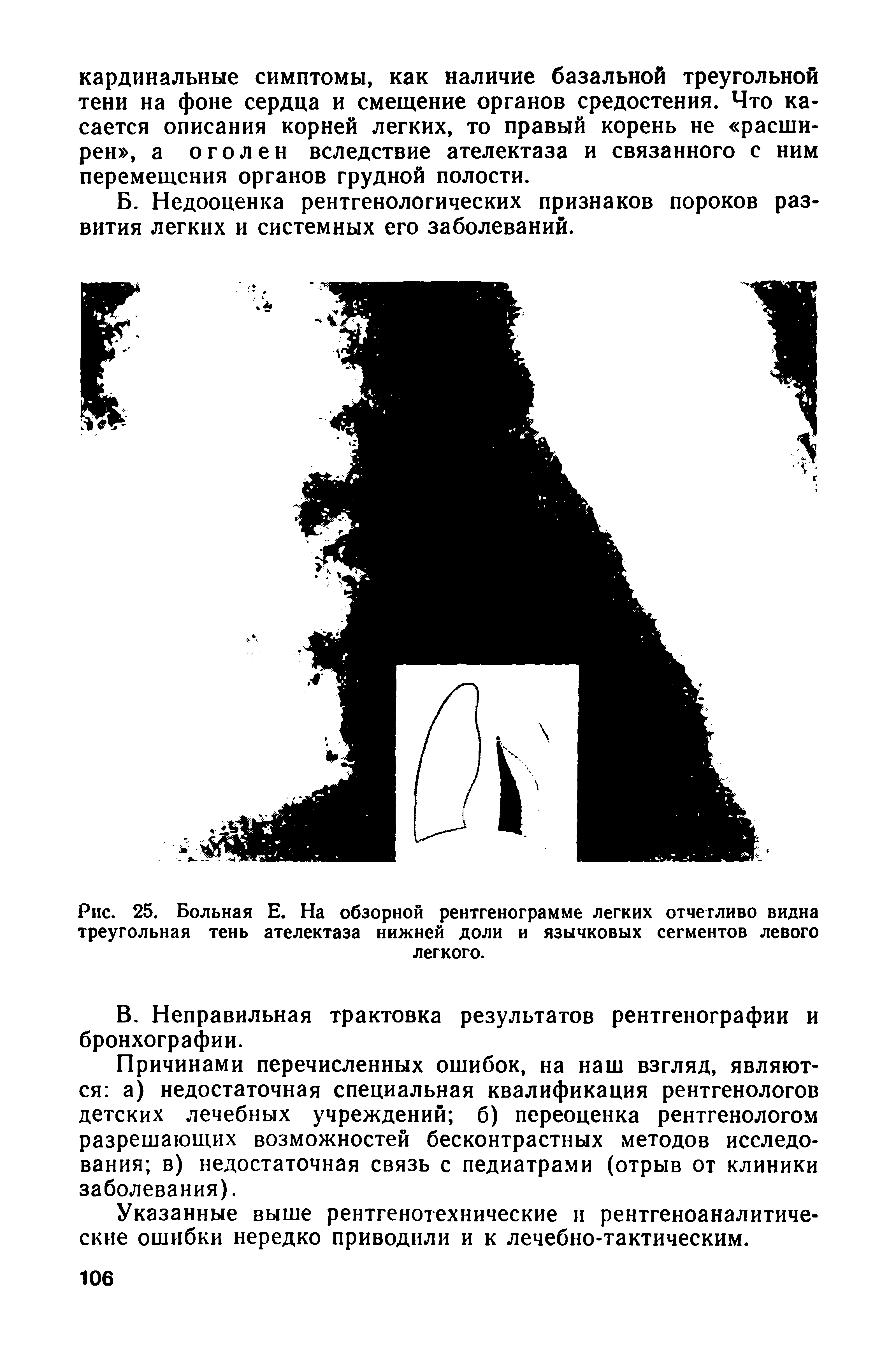 Рис. 25. Больная Е. На обзорной рентгенограмме легких отчетливо видна треугольная тень ателектаза нижней доли и язычковых сегментов левого легкого.