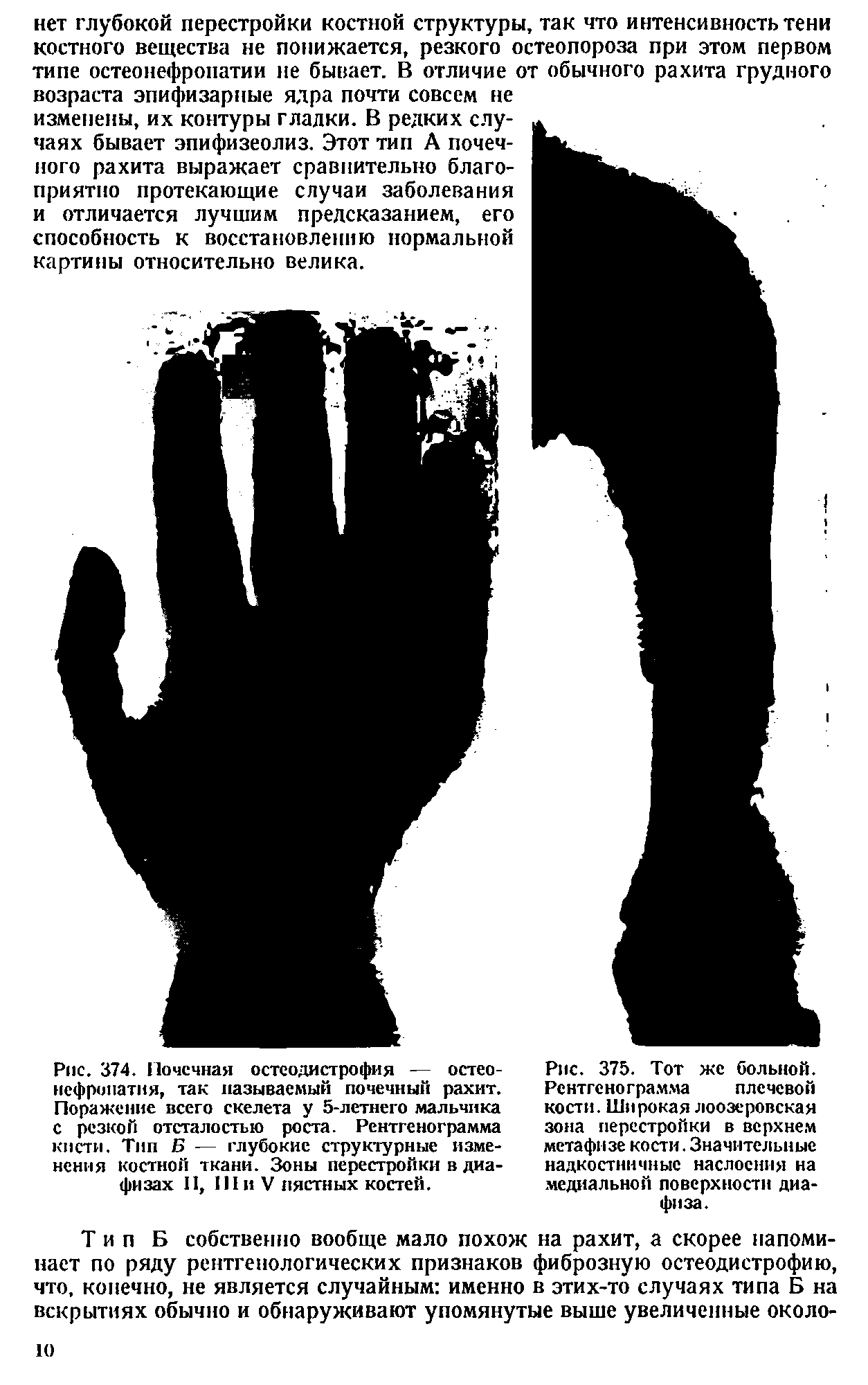 Рис. 374. Почечная остеодистрофия — остеонефропатия, так называемый почечный рахит. Поражение всего скелета у 5-летнего мальчика с резкой отсталостью роста. Рентгенограмма кисти. Тип Б — глубокие структурные изменения костной ткани. Зоны перестройки в диафизах II, 111 и V пястных костей.
