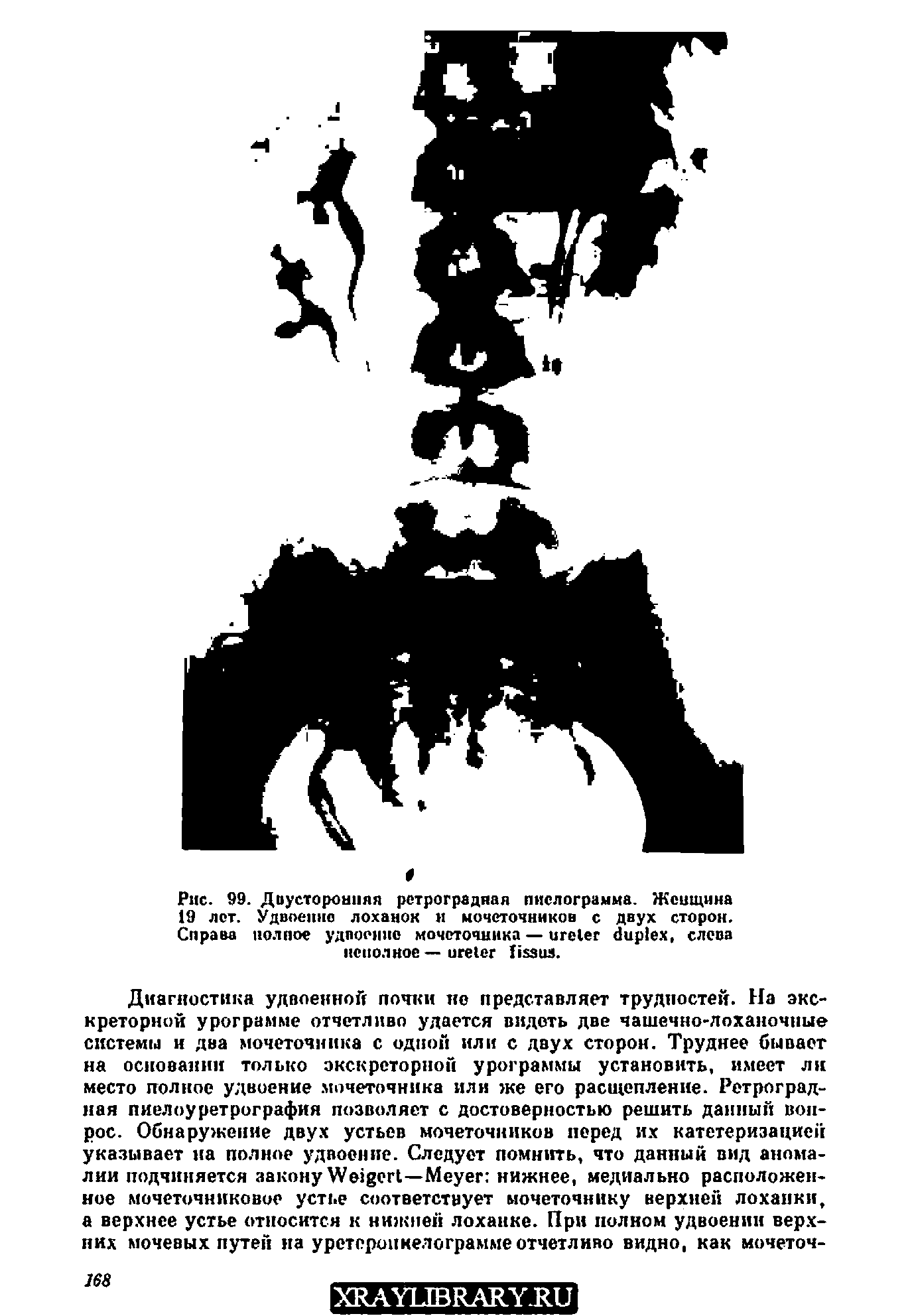 Рис. 99. Двусторонняя ретроградная пислограмма. Женщина 19 лет. Удвоенно лоханок и мочеточников с двух сторон. Справа полное удпоеннс мочеточника — , слева неполное — .