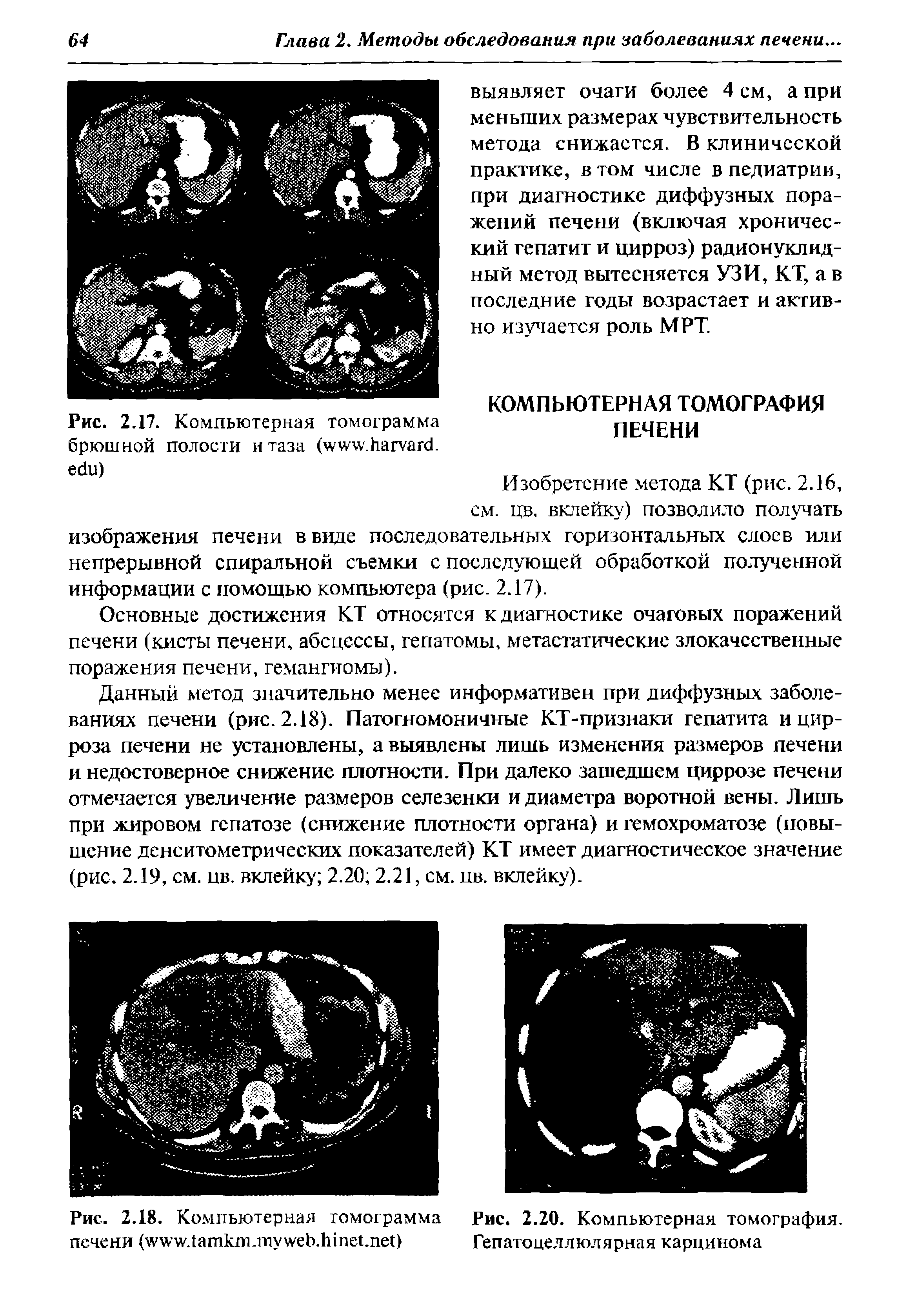 Рис. 2.18. Компьютерная томограмма Рис. 2.20. Компьютерная томография, печени ( . . . . ) Гепатоцеллюлярная карцинома...