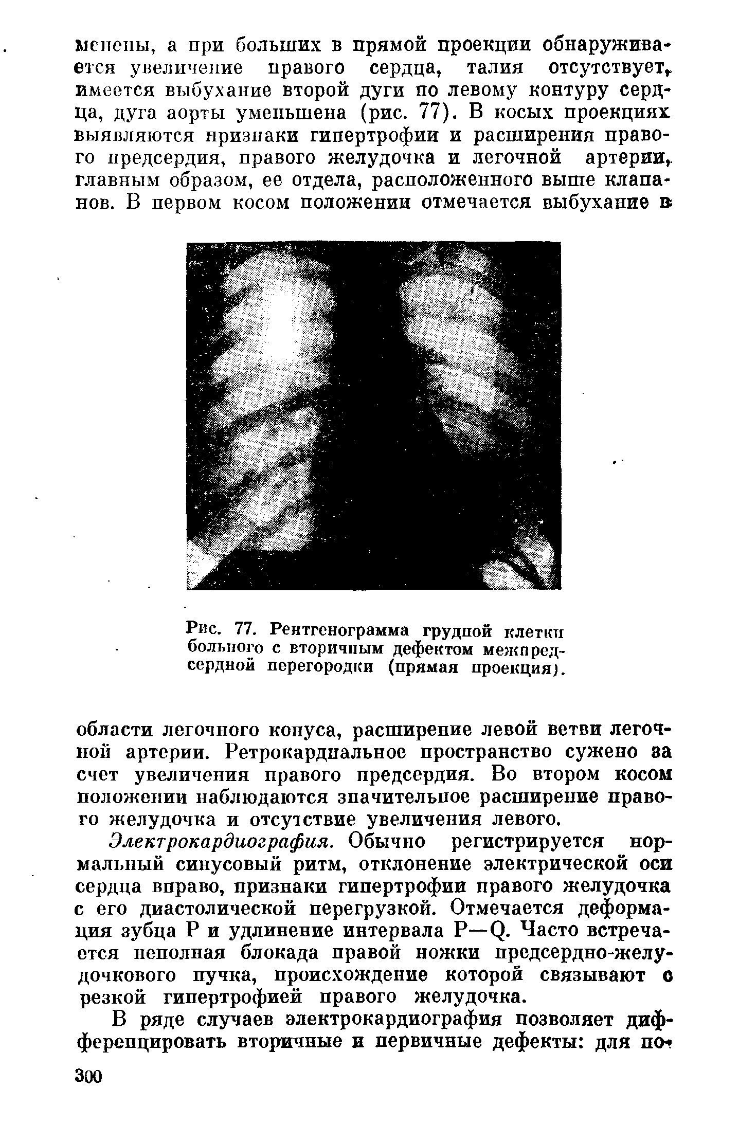Рис. 77. Рентгенограмма грудной клетки больпого с вторичным дефектом межпредсердной перегородки (прямая проекция).