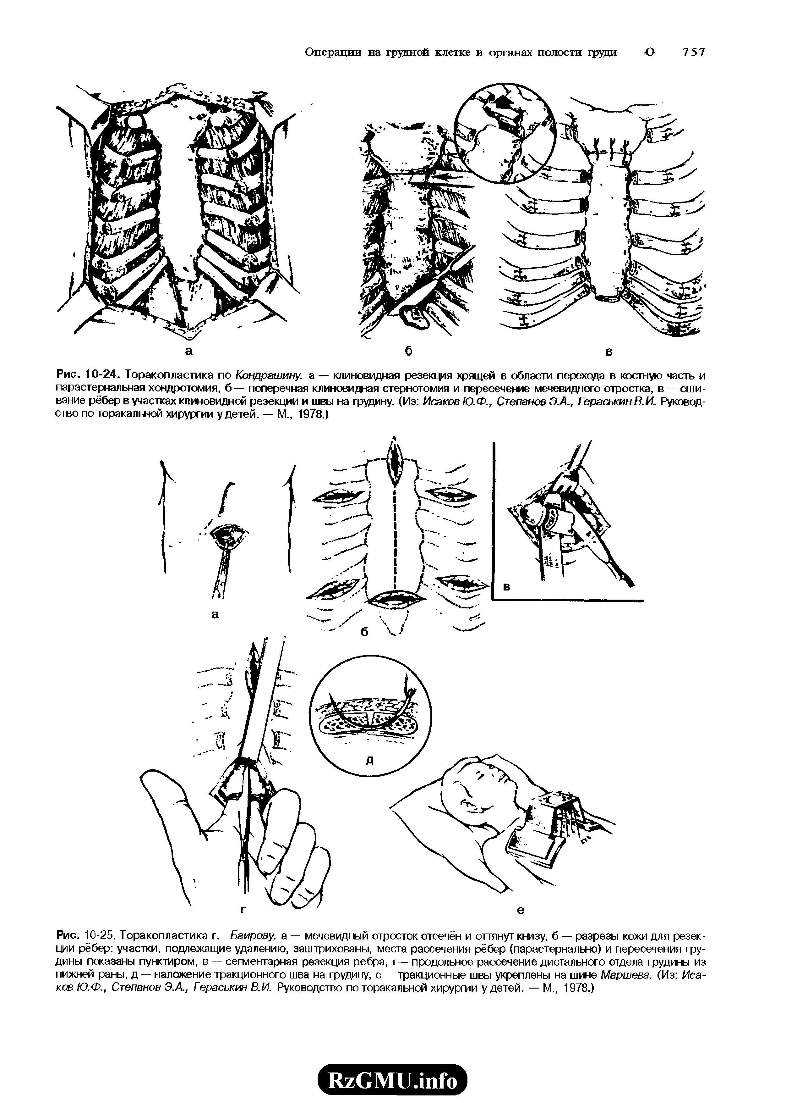 Рис. 10-24. Торакопластика по Кондрашину, а — клиновидная резекция хрящей в области перехода в костную часть и парастернальная хондротомия, б — поперечная клиновидная стернотомия и пересечение мечевидного отростка, в — сшивание рёбер в участках клиновидной резекции и швы на грудину. (Из Исаков Ю.Ф., Степанов Э.А., Гераськин В.И. Руководство по торакальной хирургии у детей. — М., 1978.)...