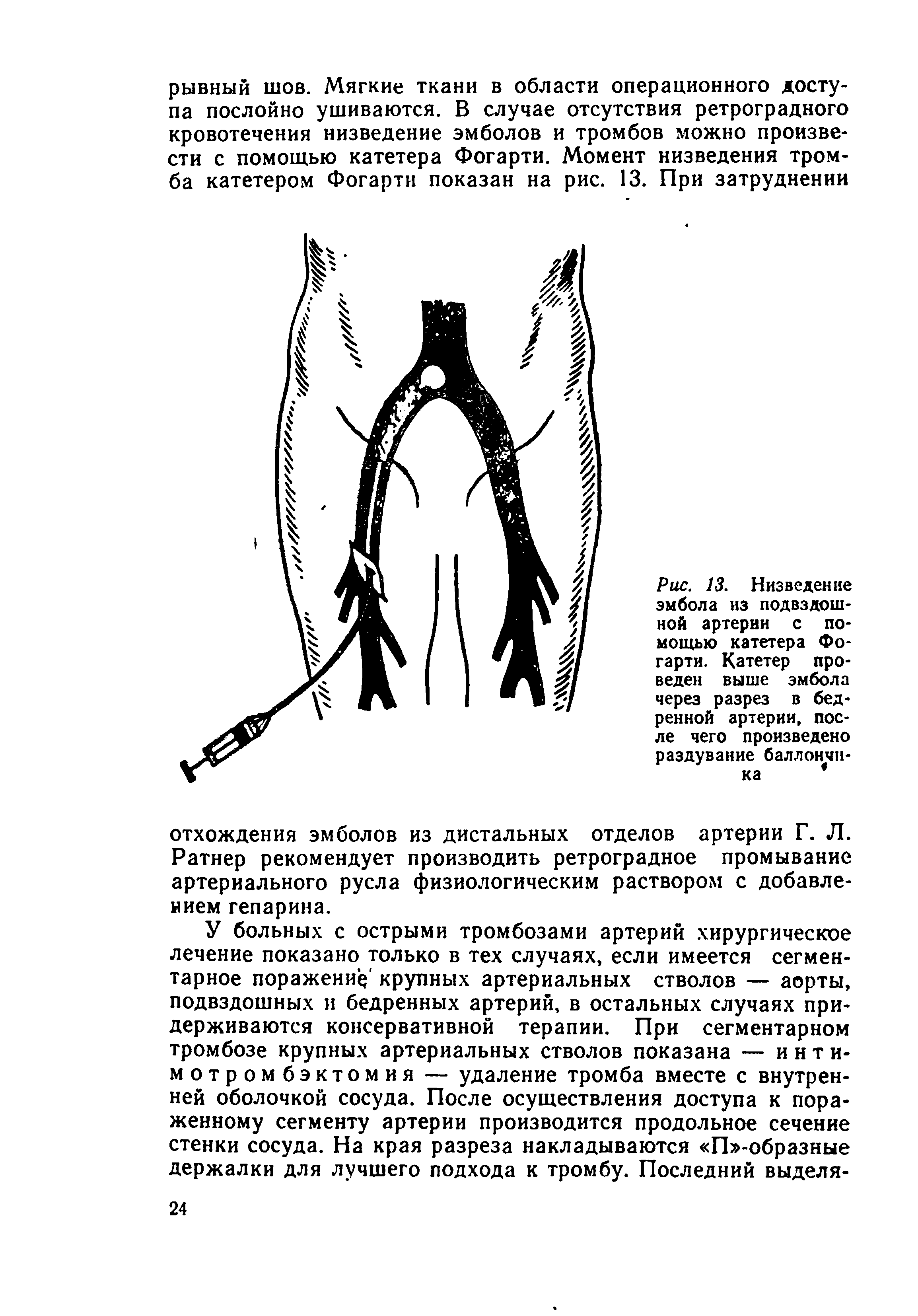 Рис. 13. Низведение эмбола из подвздошной артерии с помощью катетера Фогарти. Катетер проведен выше эмбола через разрез в бедренной артерии, после чего произведено раздувание баллончика ...