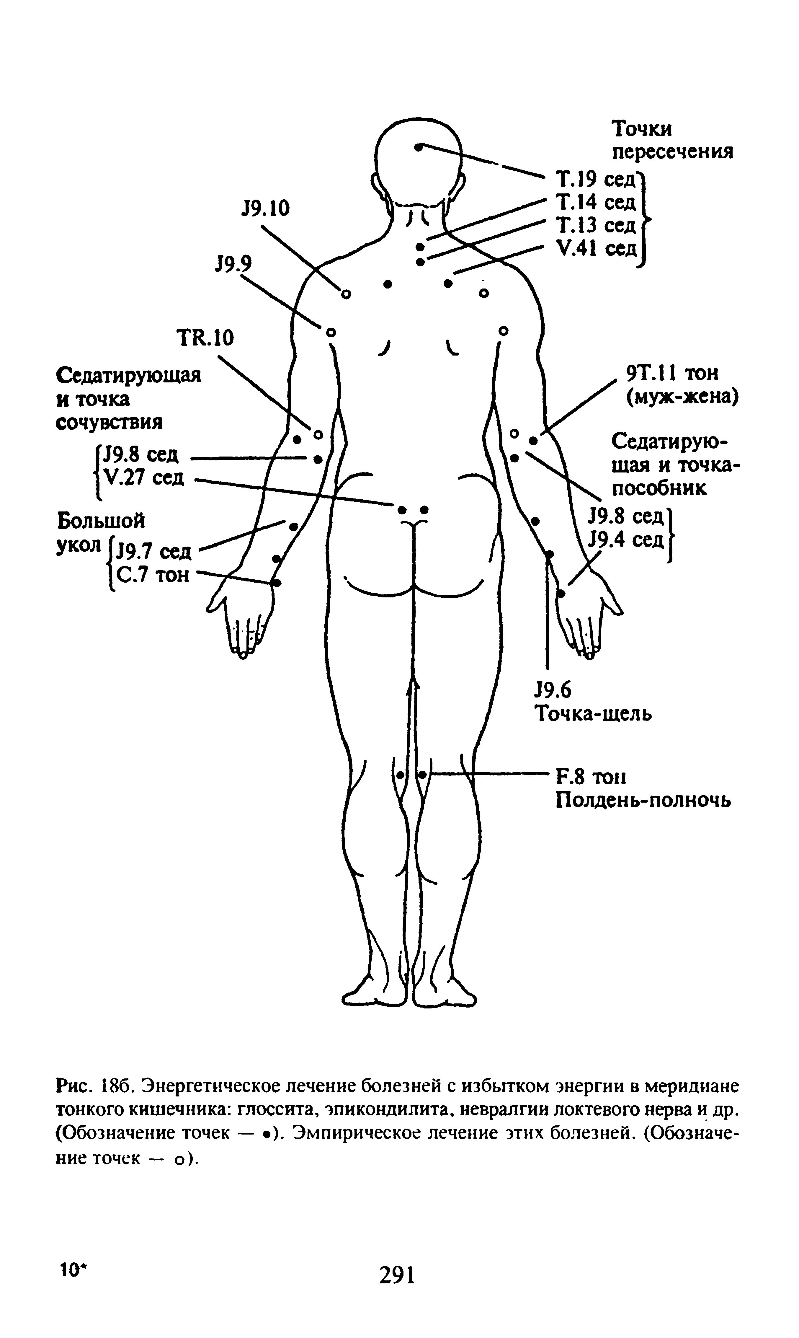 Рис. 186. Энергетическое лечение болезней с избытком энергии в меридиане тонкого кишечника глоссита, эпикондилита, невралгии локтевого нерва и др. (Обозначение точек — ). Эмпирическое лечение этих болезней. (Обозначение точек — о).
