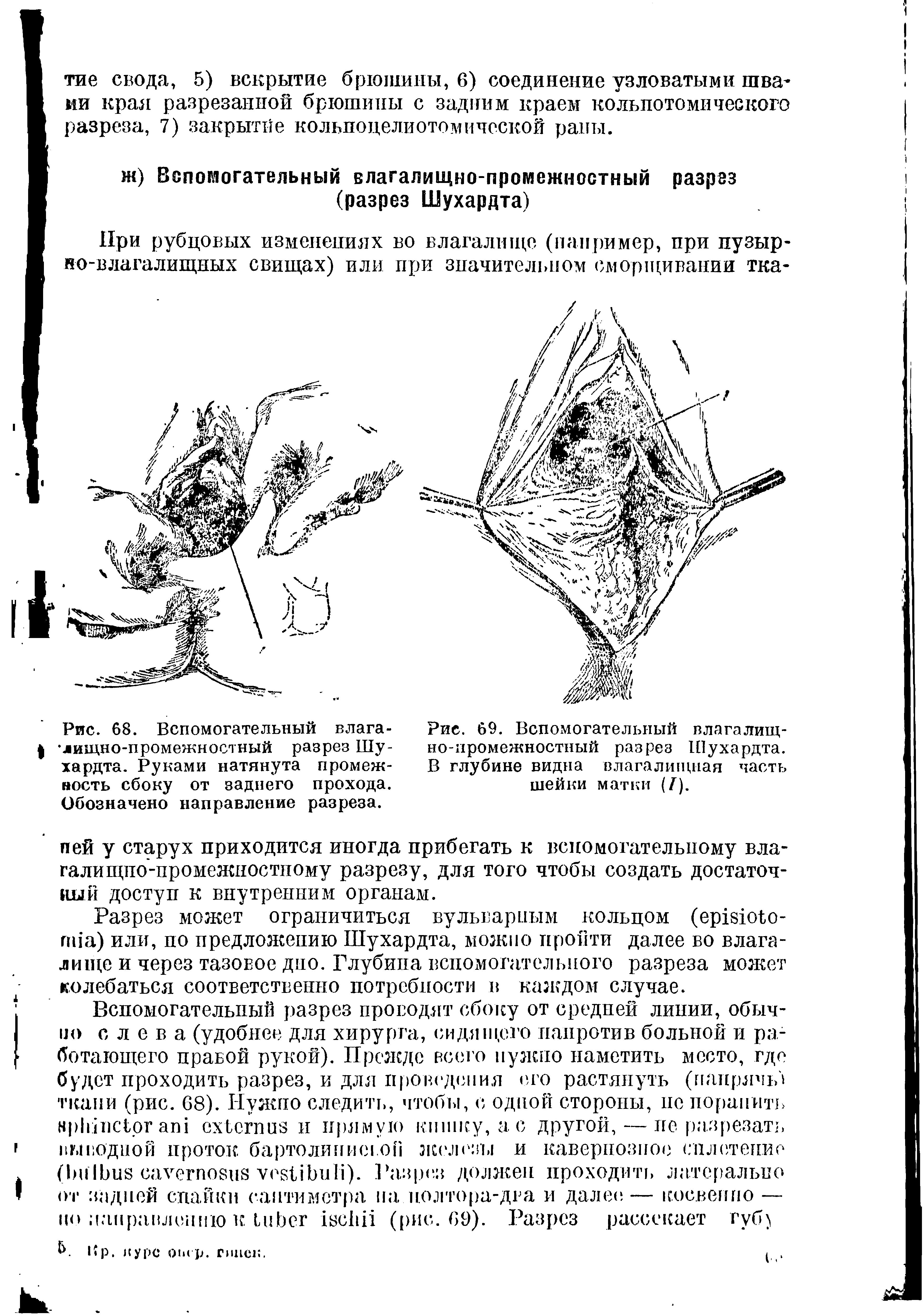 Рис. 68. Вспомогательный влага- лищно-промежностный разрез Шухардта. Руками натянута промежность сбоку от заднего прохода. Обозначено направление разреза.