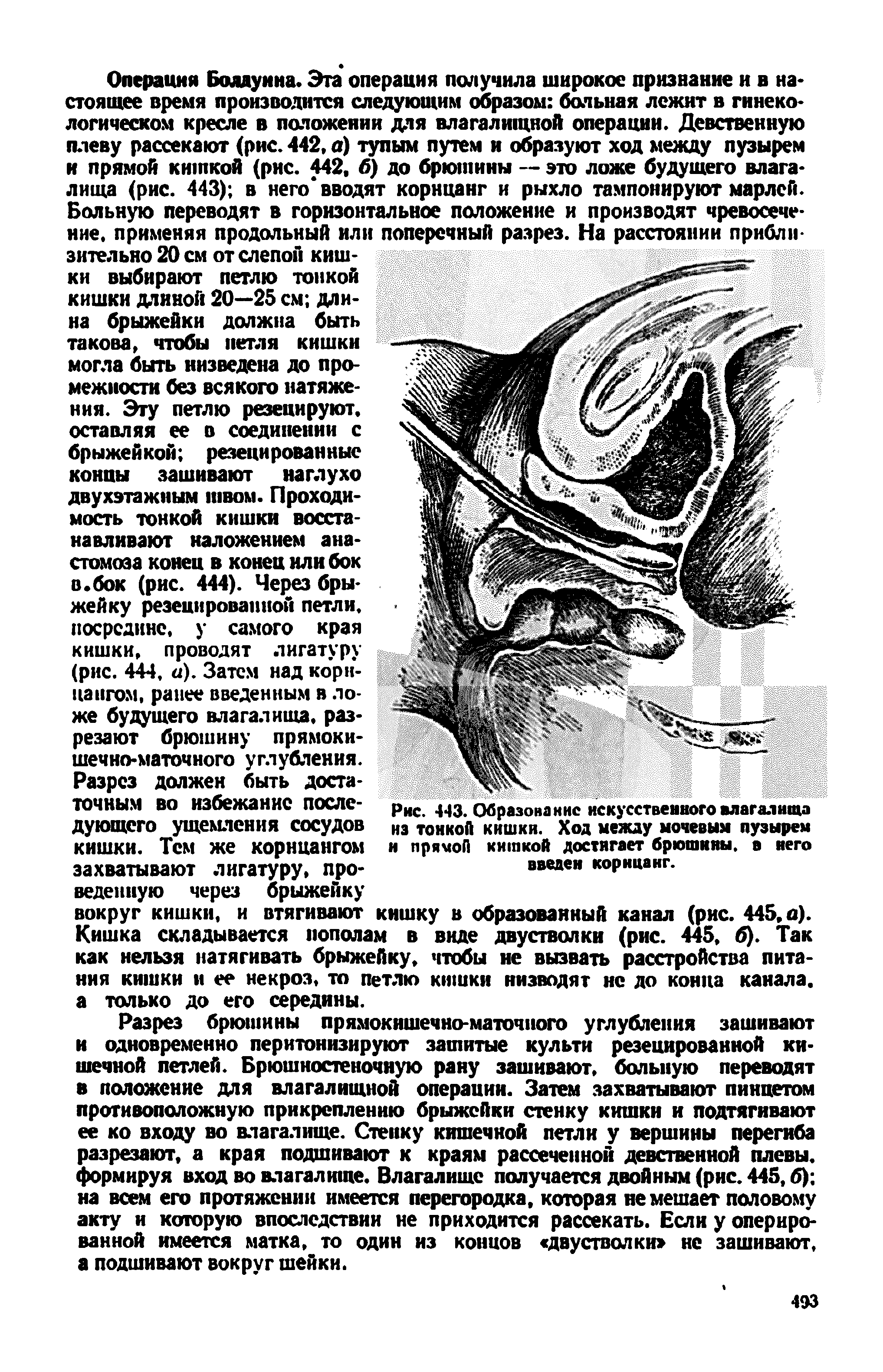 Рис. 443. Образование искусственного влагалища из тонкой кишки. Ход между мочевым пузырем и прямой кишкой достигает брюшины, в него введем корнцанг.