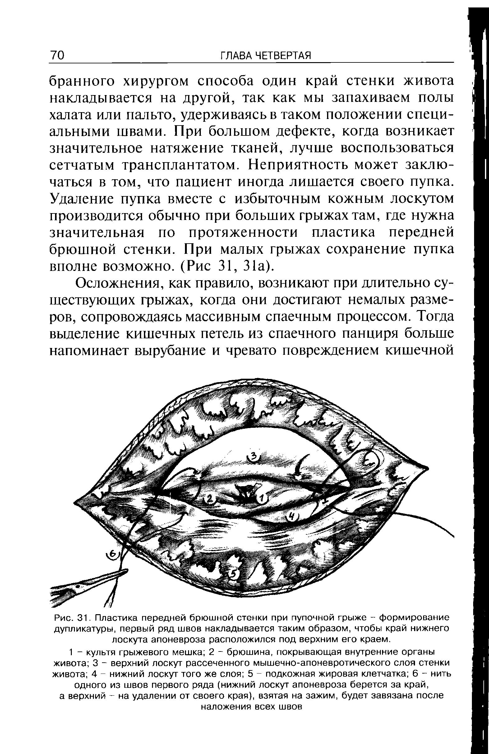 Рис. 31. Пластика передней брюшной стенки при пупочной грыже - формирование дупликатуры, первый ряд швов накладывается таким образом, чтобы край нижнего лоскута апоневроза расположился под верхним его краем.