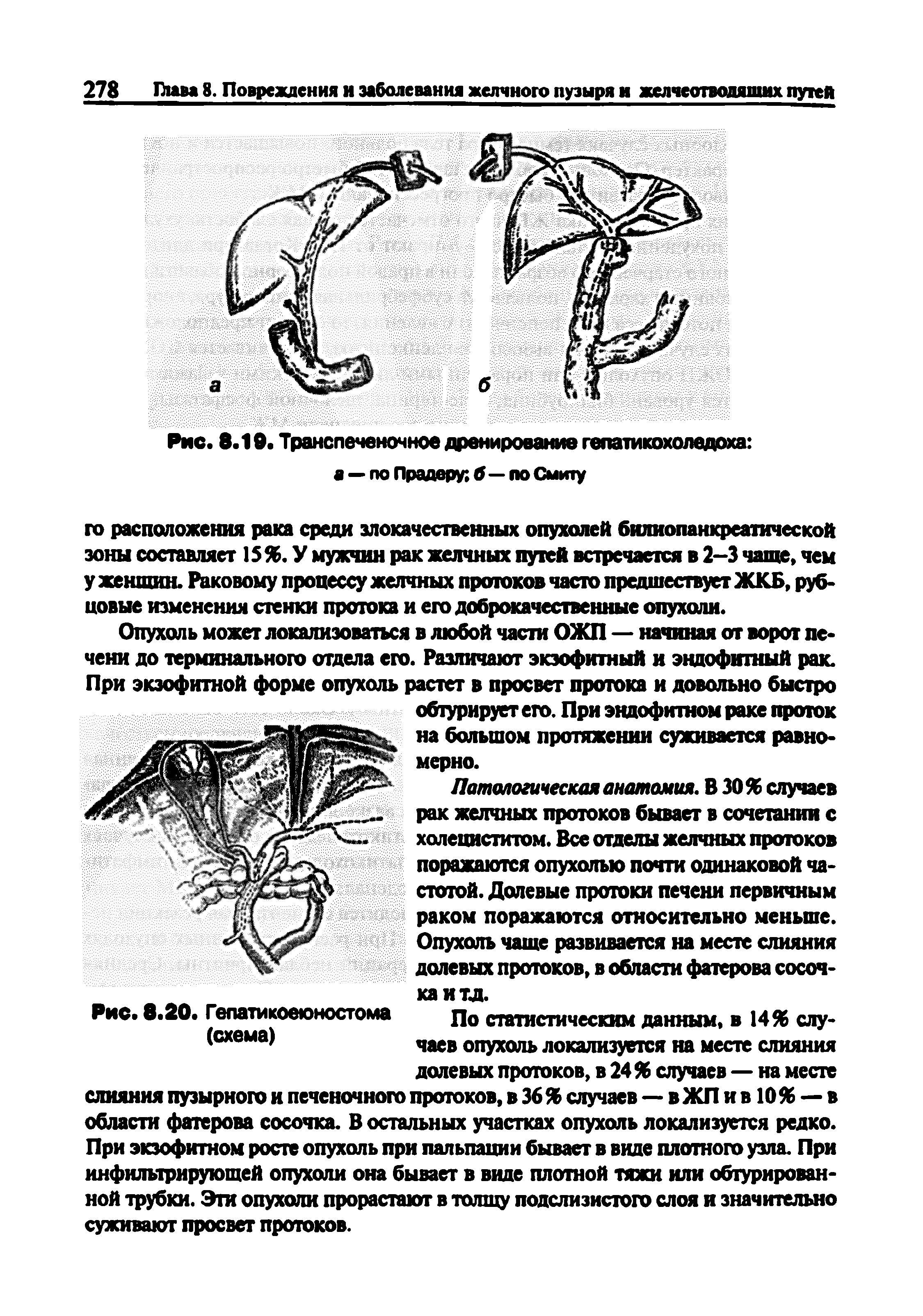 Рис. 8.20. Гепатикоеюностома По статистическим данным, в 14% слу-(схема) чаев опухояь локализуется на месте слияния...