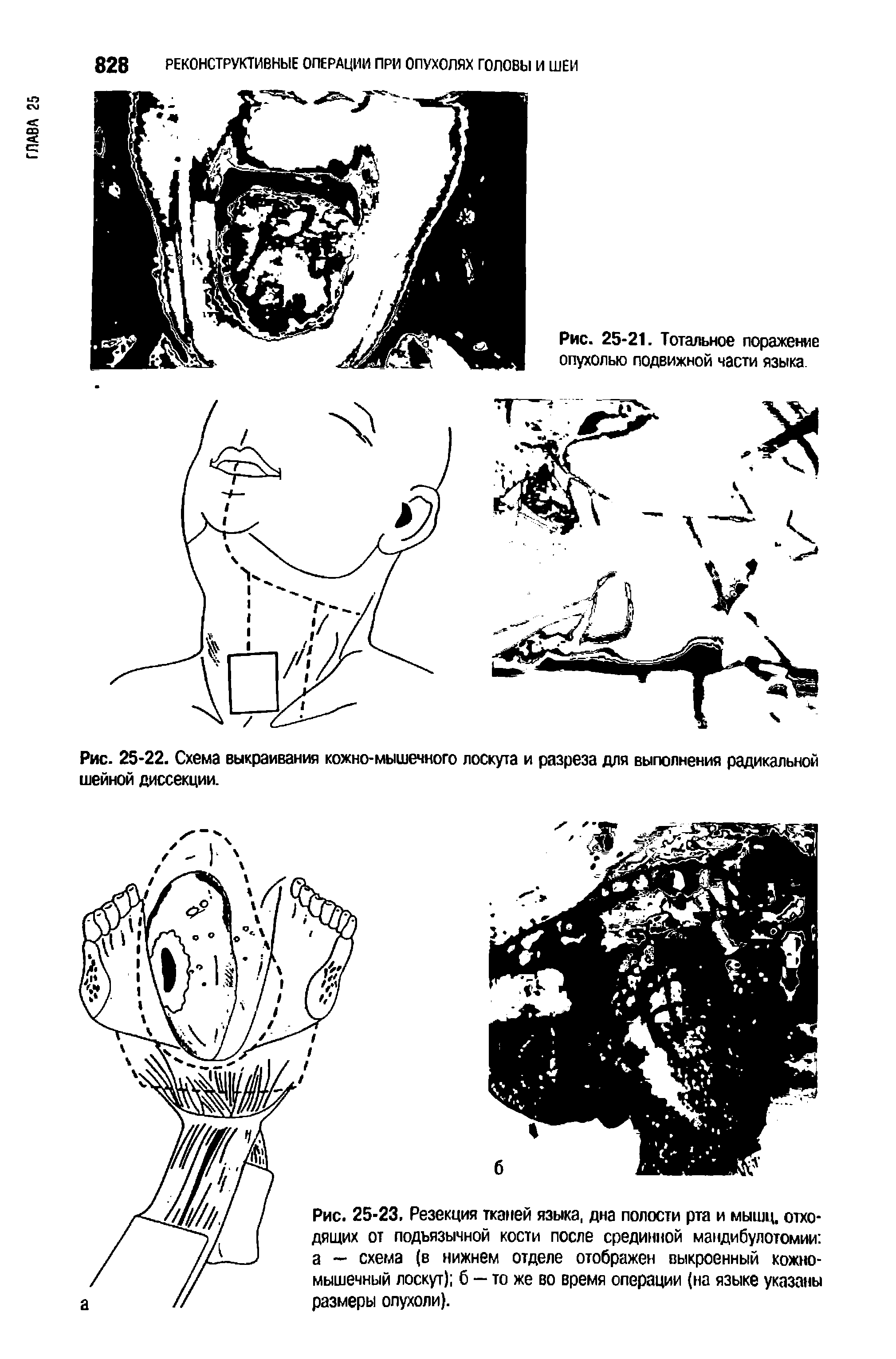 Рис. 25-23. Резекция тканей языка, дна полости рта и мышц, отходящих от подъязычной кости после срединной мандибулотомии а — схема (в нижнем отделе отображен выкроенный кожномышечный лоскут) б — то же во время операции (на языке указаны размеры опухоли).