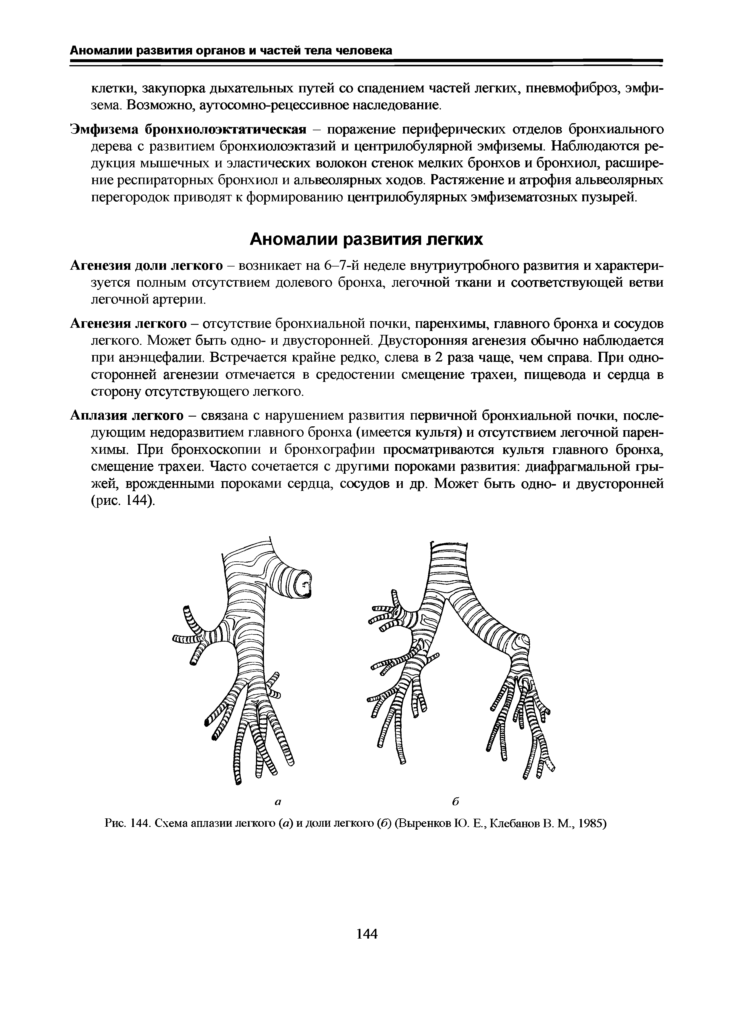 Рис. 144. Схема аплазии легкого (а) и доли легкого (б) (Выренков Ю. Е., Клебанов В. М., 1985)...