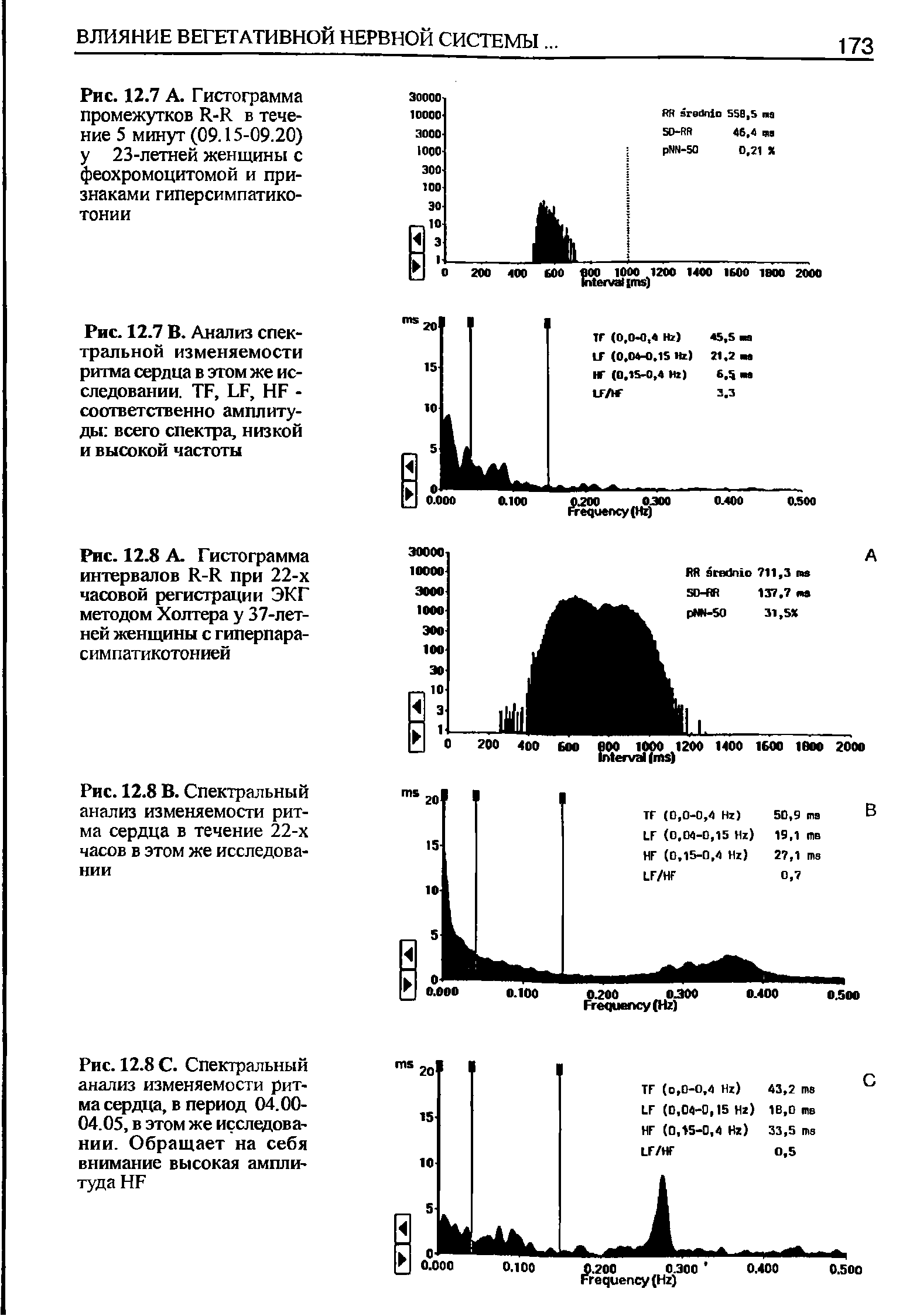 Рис. 12.7 В. Анализ спектральной изменяемости ритма сердца в этом же исследовании. ТГ, и, НБ -соответственно амплитуды всего спектра, низкой и высокой частоты...