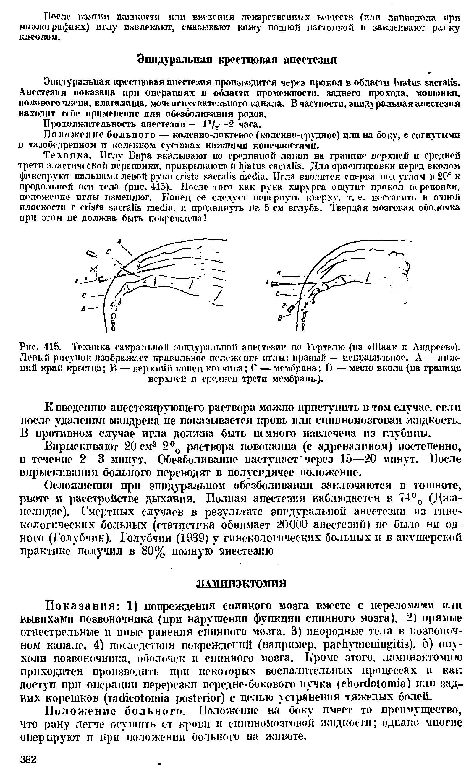 Рис. 415. Техника сакральной эппдуралыюй анестезии по Гертелю (из Шаак и Андреев ). Левый рисунок изображает правильное положение иглы правый —неправильное. А — нижний край крестца В — верхний конец копчика С — мембрана О — место вкола (на границе верхней п средней трети мембраны).